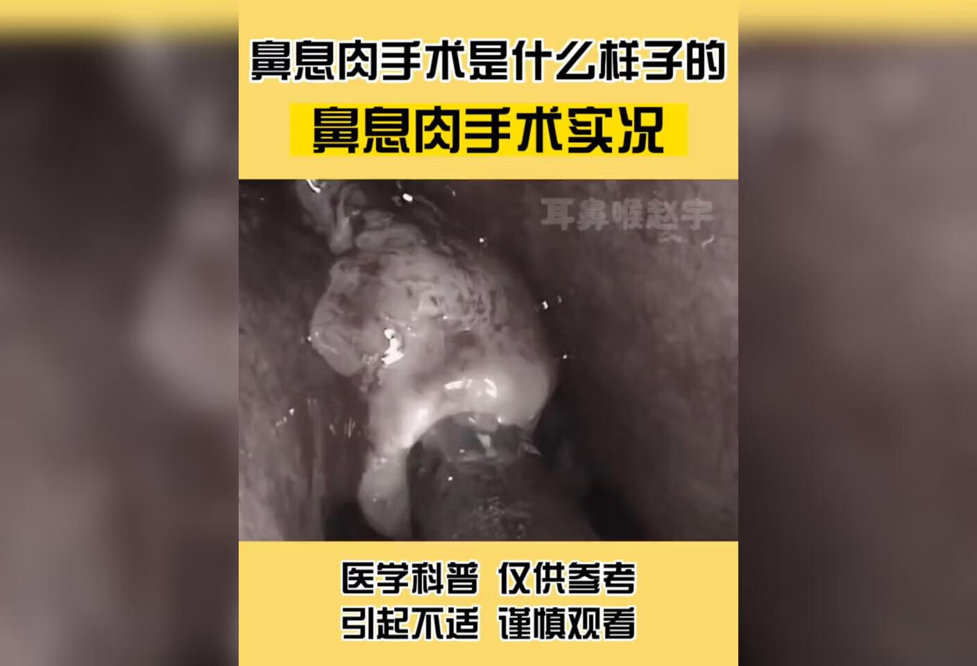 鼻息肉手术是什么样的？ 