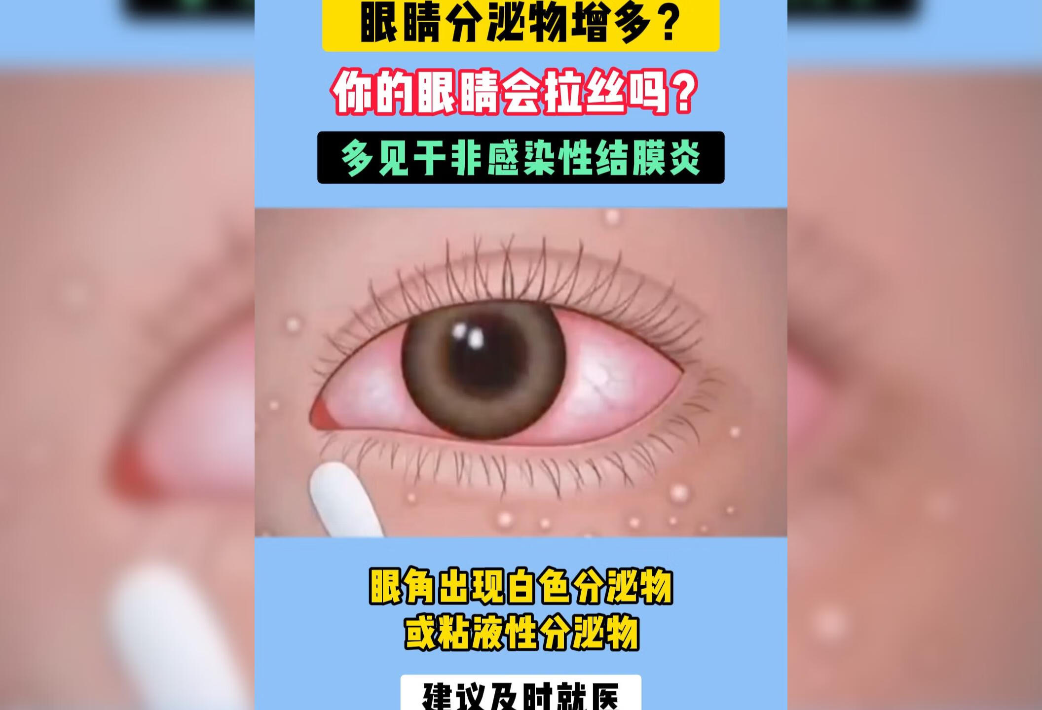 非感染性结膜炎会使眼分泌物增多