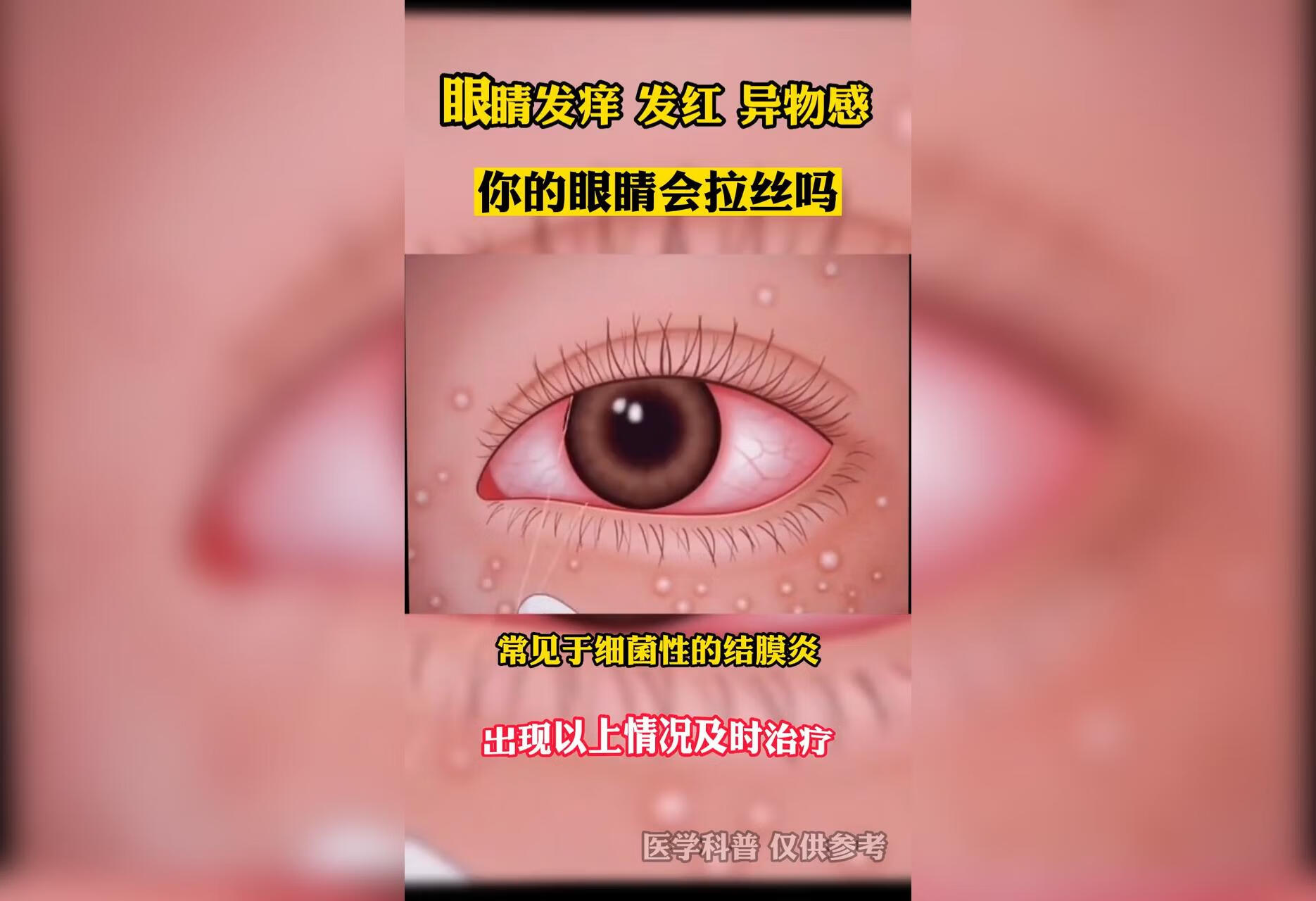 出现这些症状可能是过敏性结膜炎