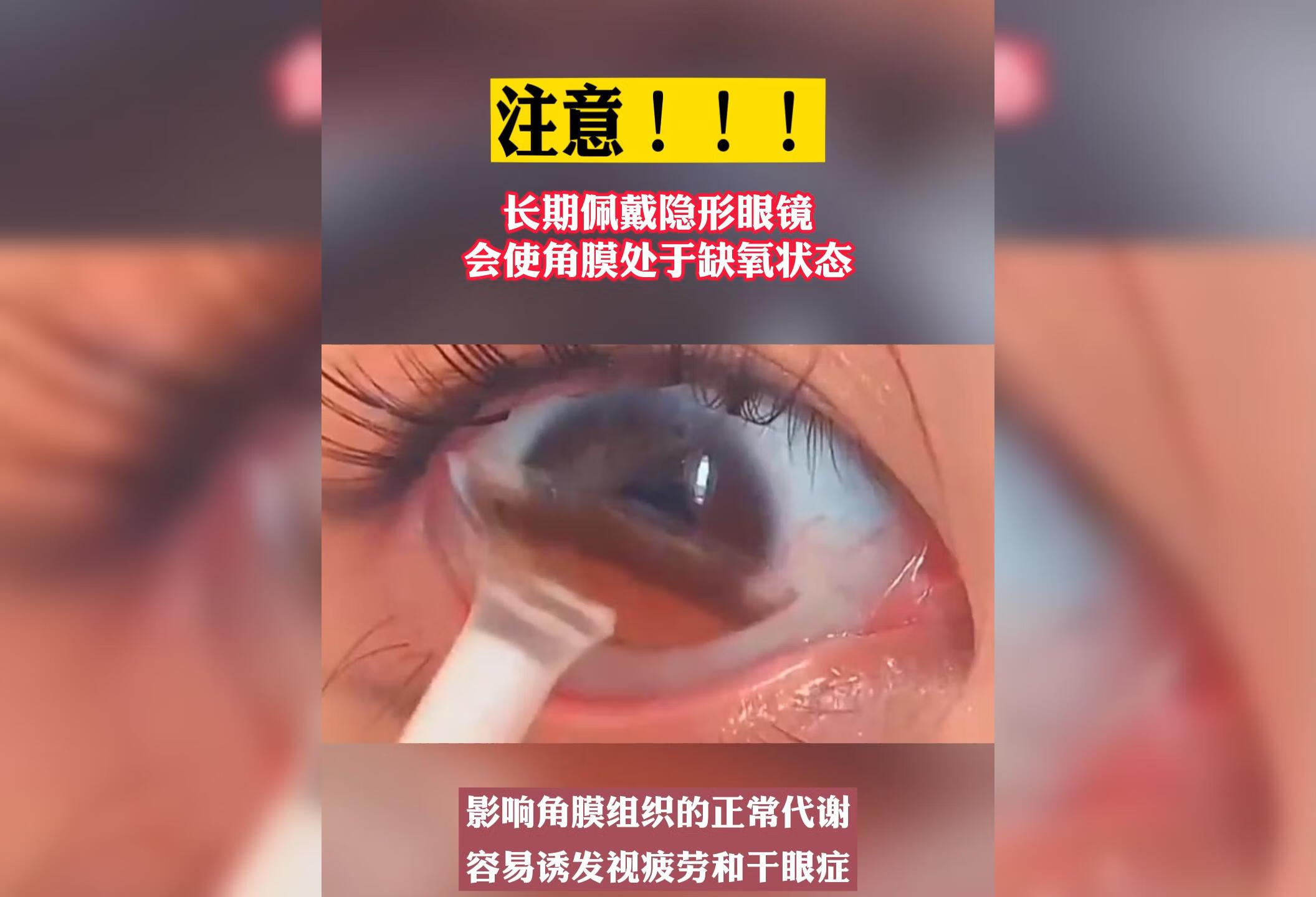 长期佩戴隐形眼镜 ，会使角膜处于缺氧状态