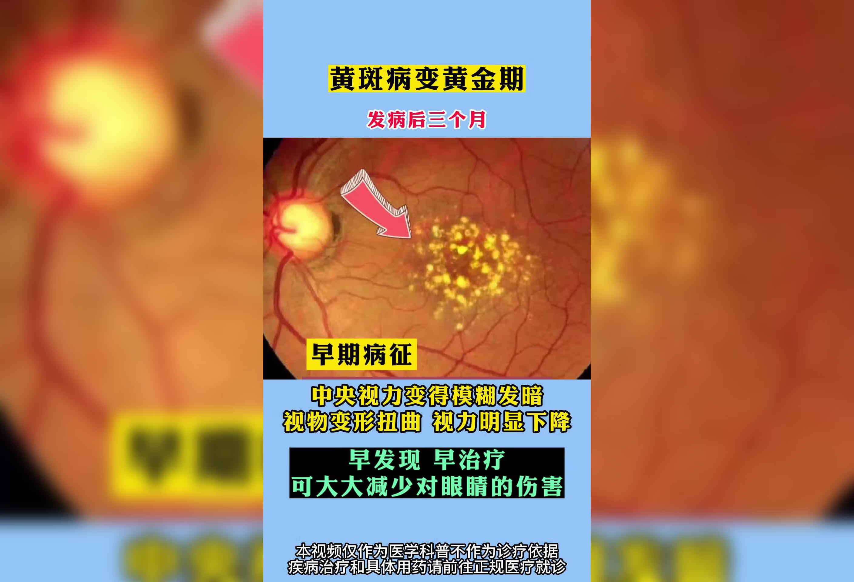 黄斑病变黄金期的表现