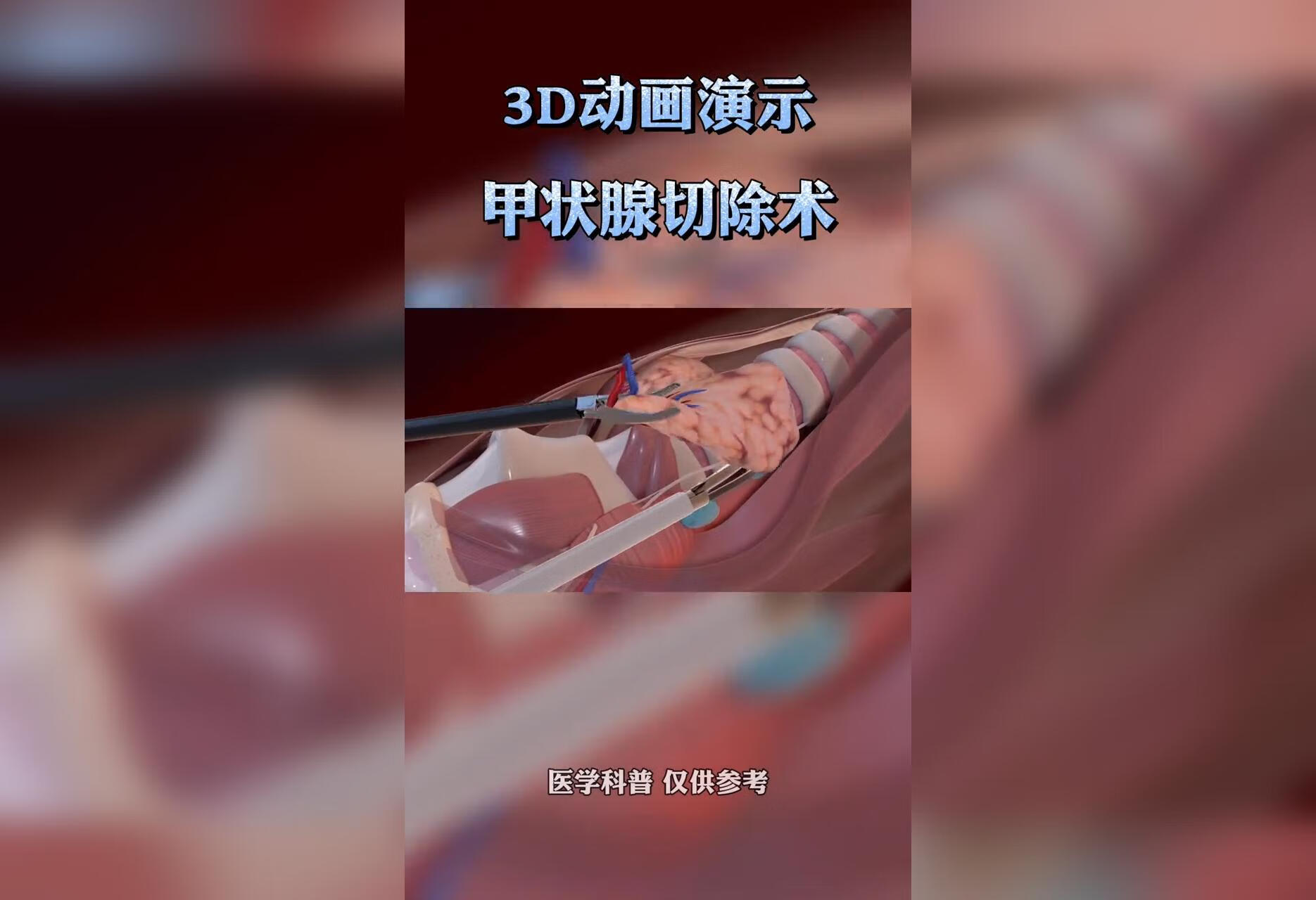 3D动画演示甲状腺手术