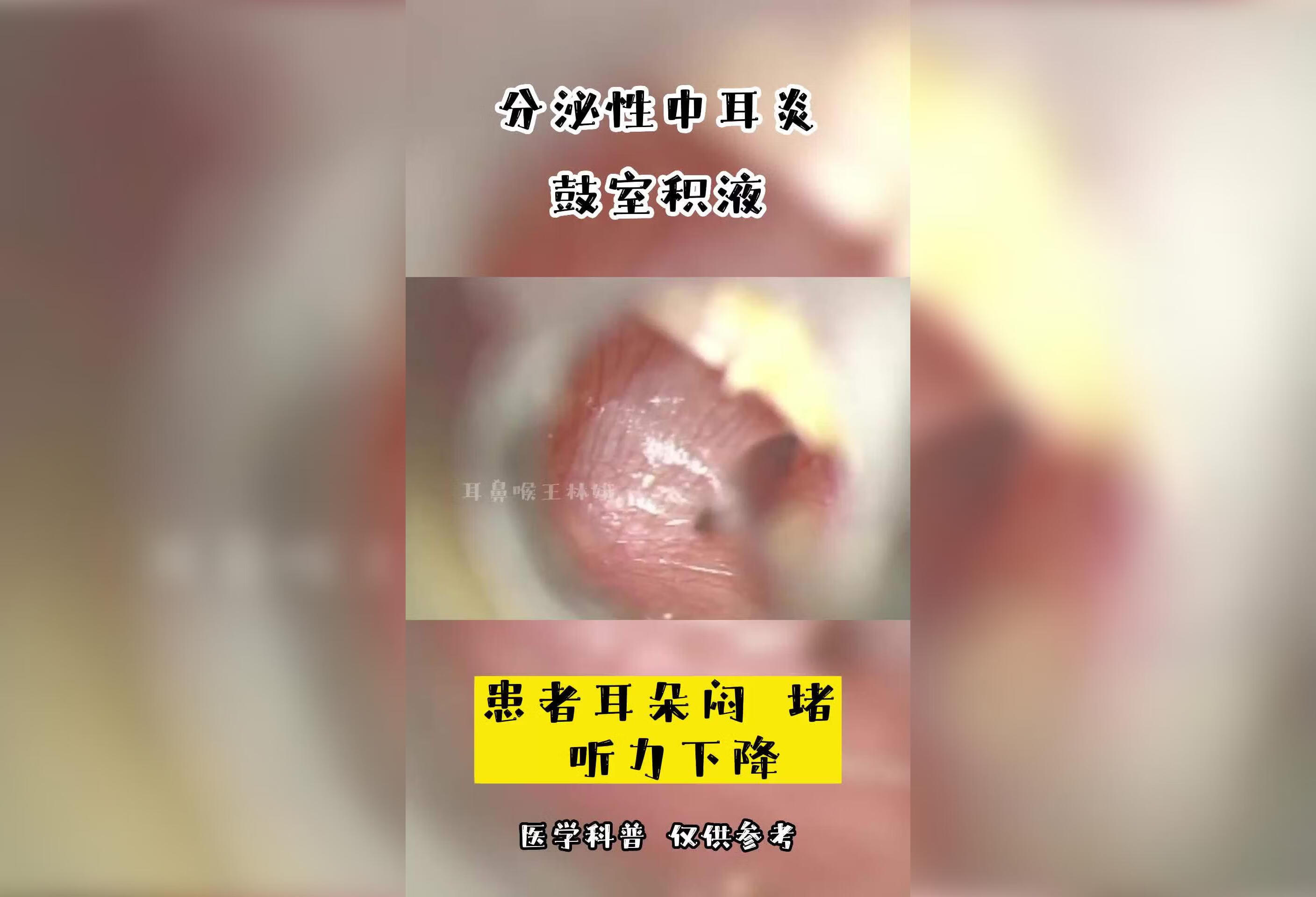 分泌性中耳炎鼓室积液会出现下列症状