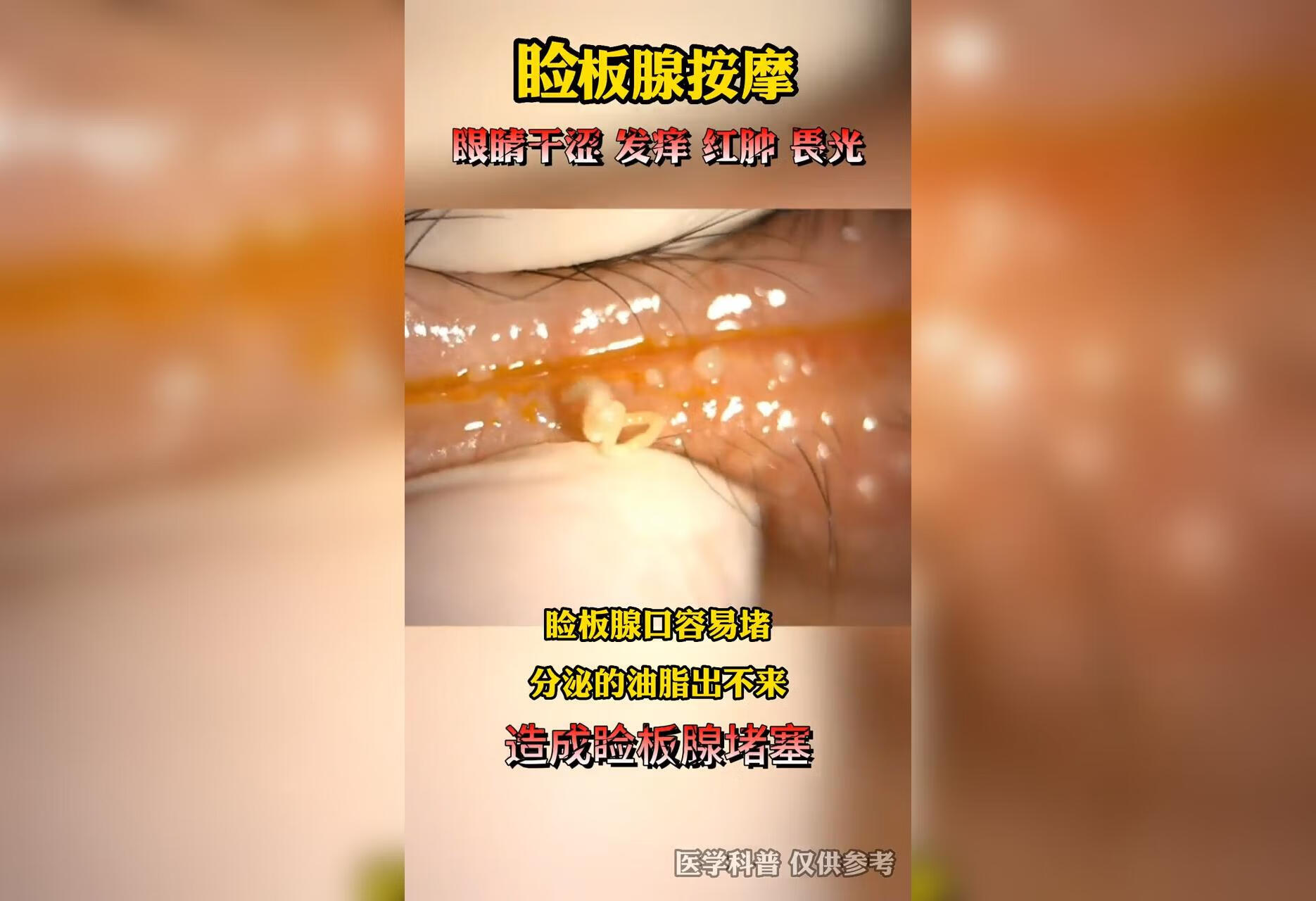 睑板腺口容易堵，分泌的油脂出不来