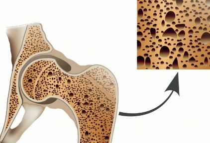 关于骨质疏松，这10个问题你一定要知道