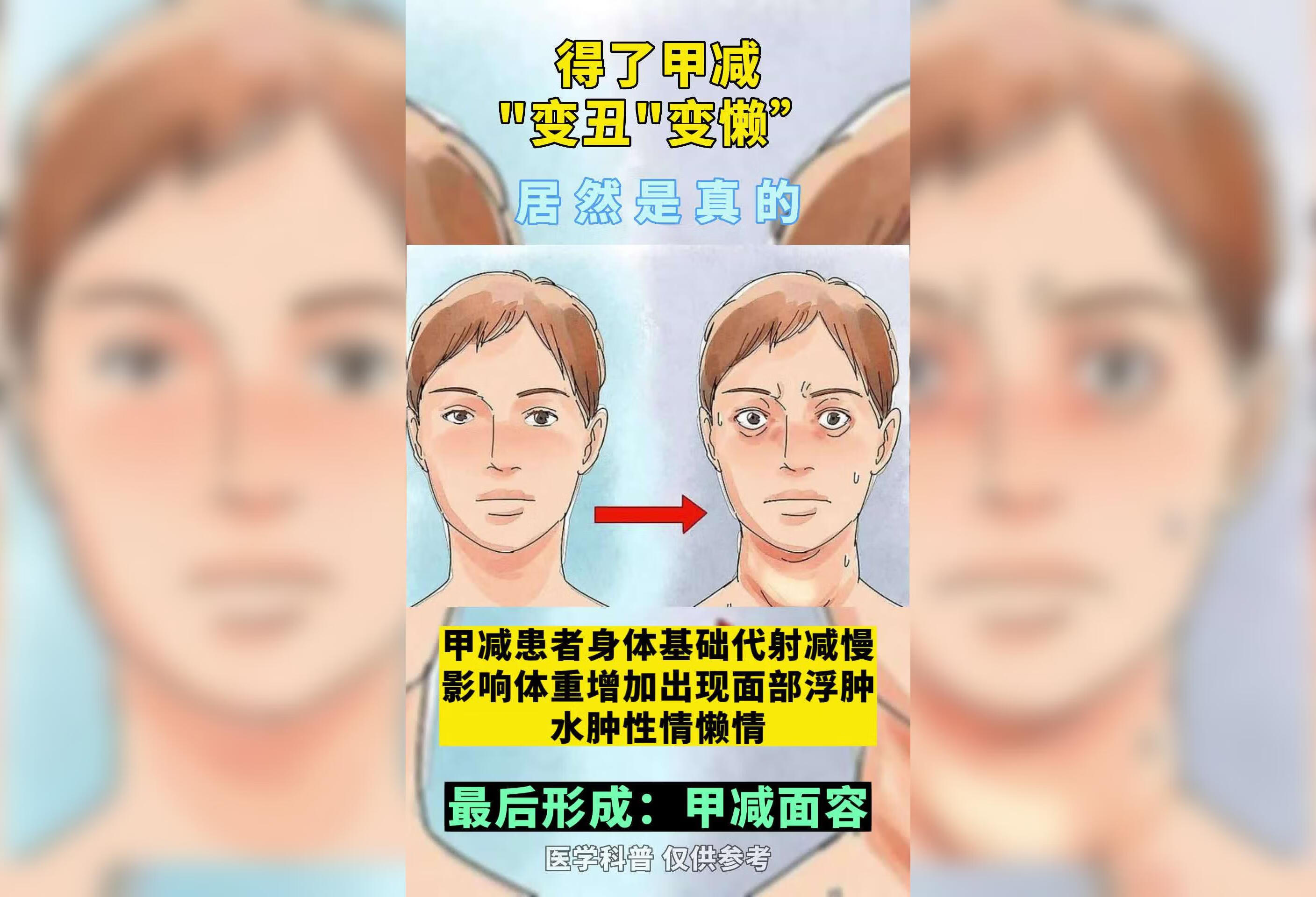 甲状腺功能减退可能导致变丑、变懒