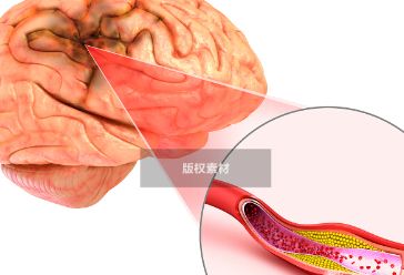 晨起头部若出现这4个“迹象”，脑部血管或已堵塞