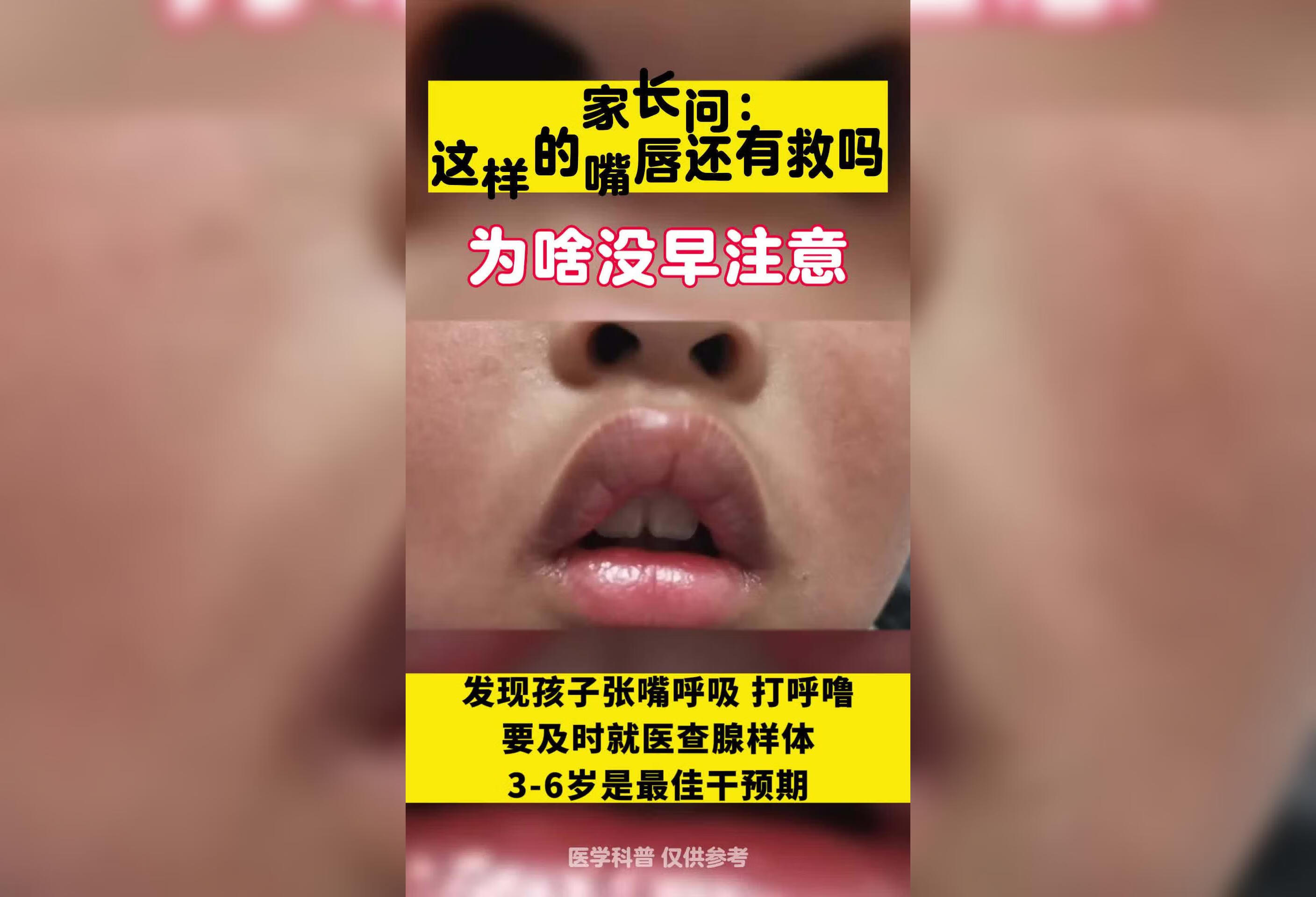 孩子张嘴呼吸和打呼噜要及时查腺样体肥大