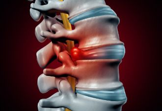 腰椎间盘突出你最该知道的事