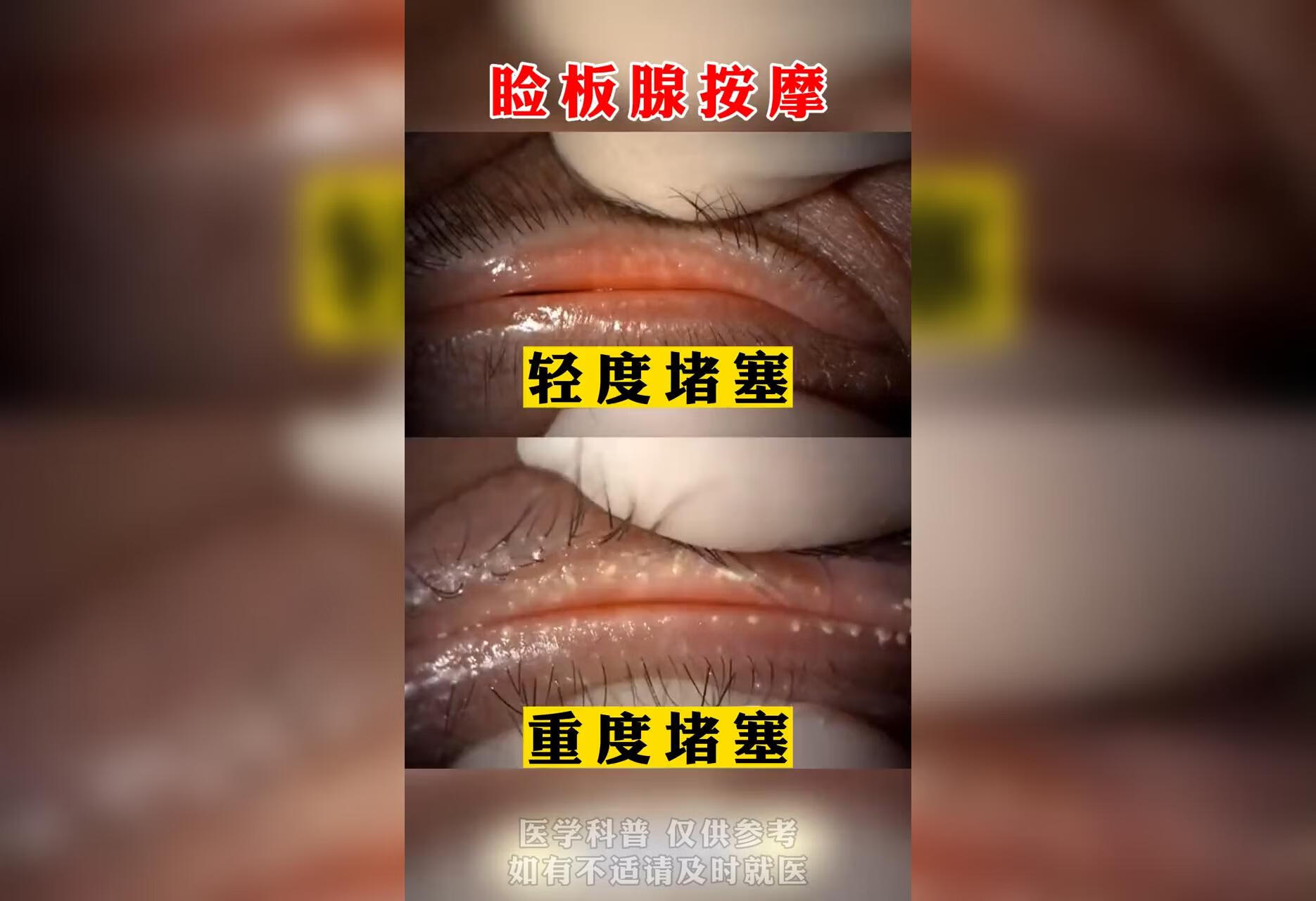 睑板腺堵塞可以做睑板腺按摩 #医学科