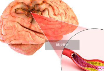 “脑梗”患者注意这几种养生方法