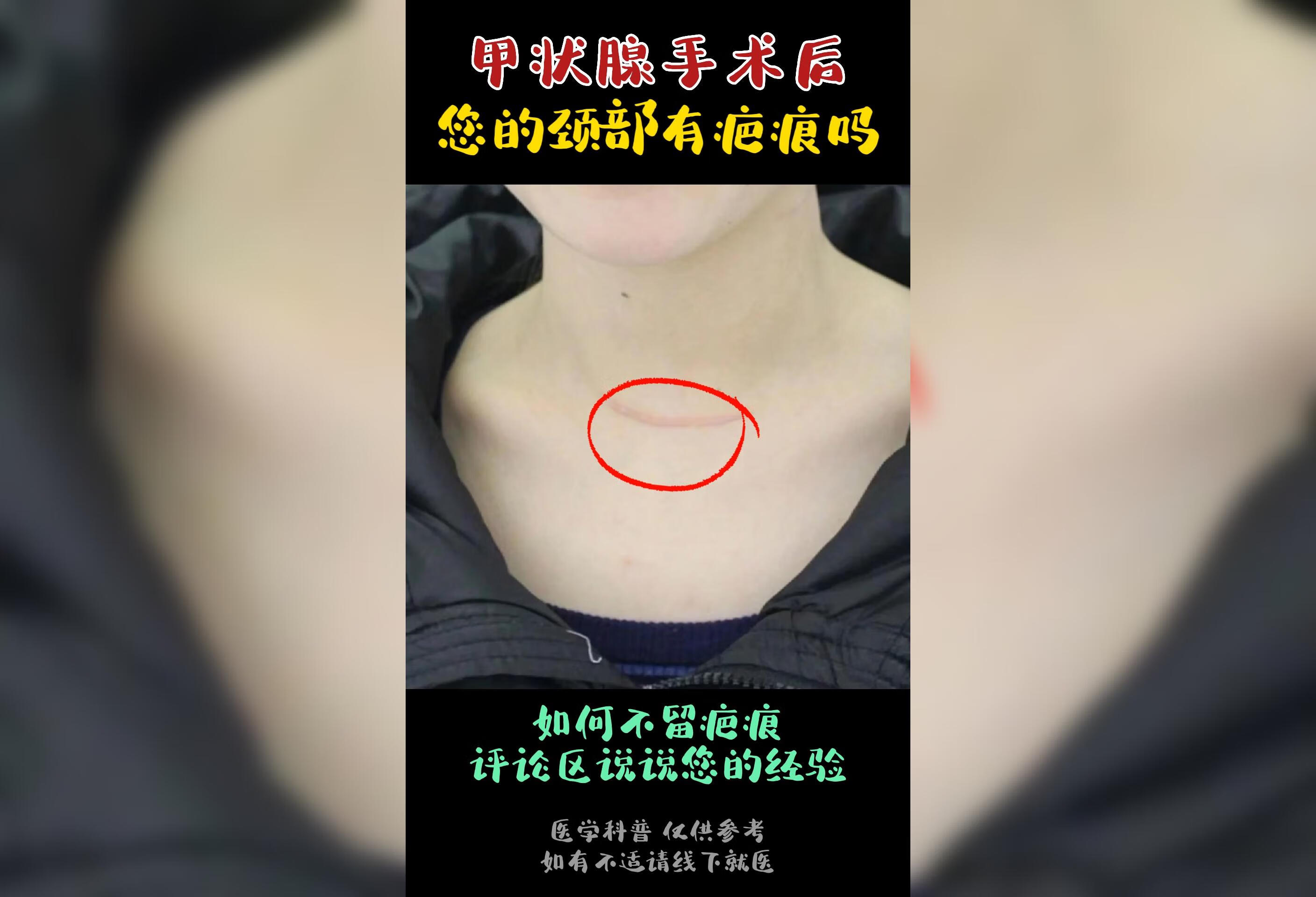 甲状腺手术后，您的颈部有疤痕吗？