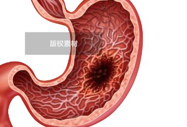 21岁大学生确诊胃癌，医生说与这些习惯密切相关