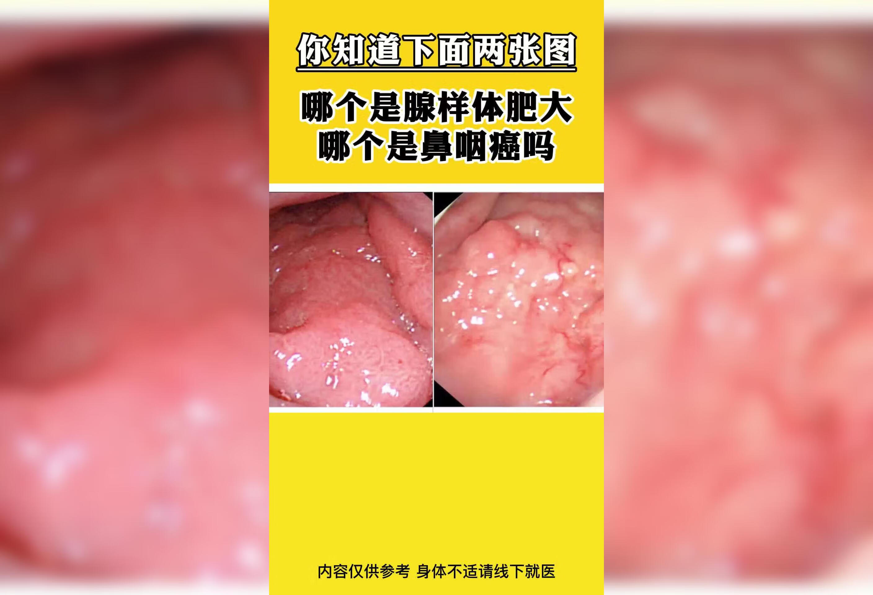 鼻咽癌、腺样体肥图片