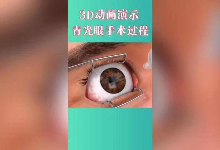 3D动画演示青光眼手术过程