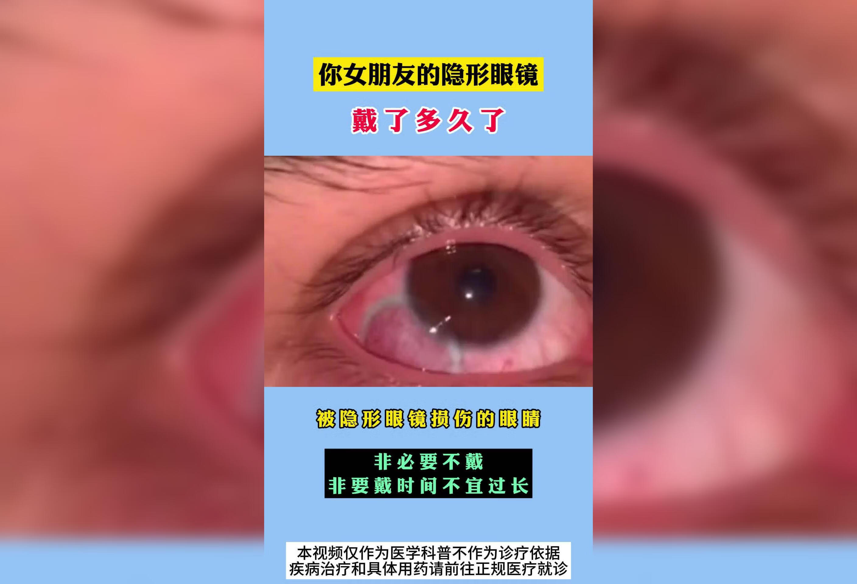 你女朋友的隐形眼镜戴了多久了？