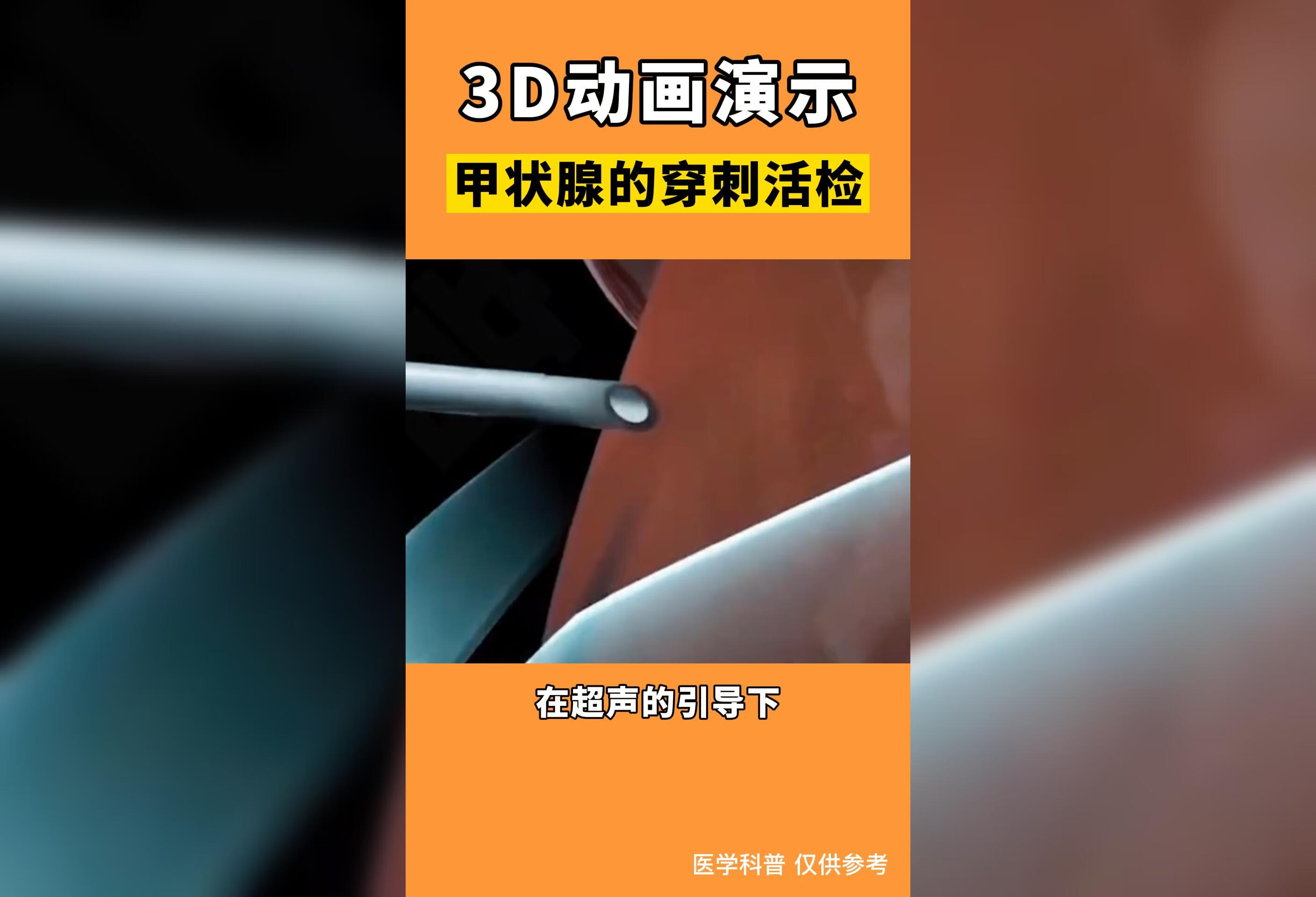 3d动画演示甲状腺结节细胞学穿刺