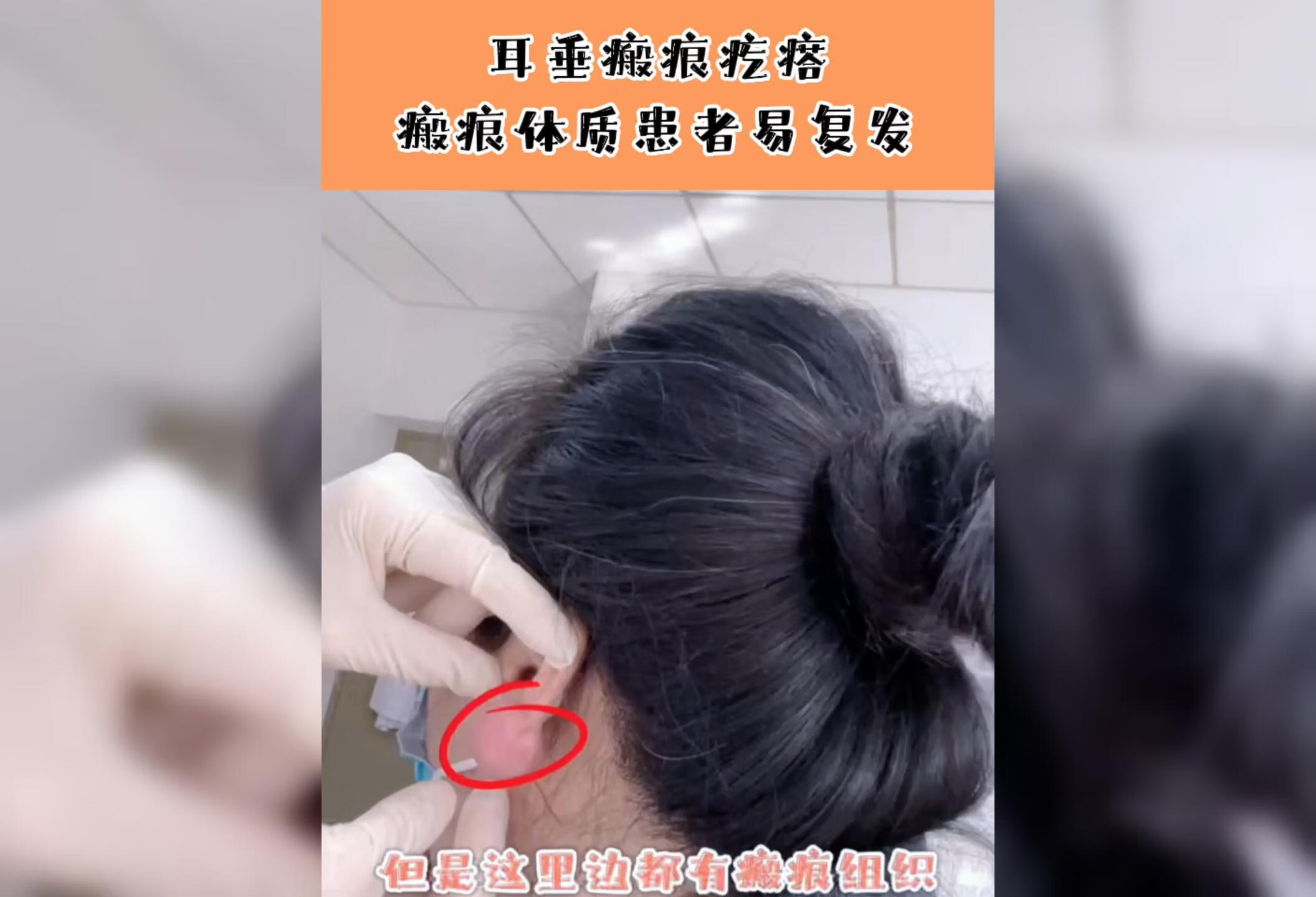 耳垂瘢痕疙瘩，瘢痕体质患者易复发