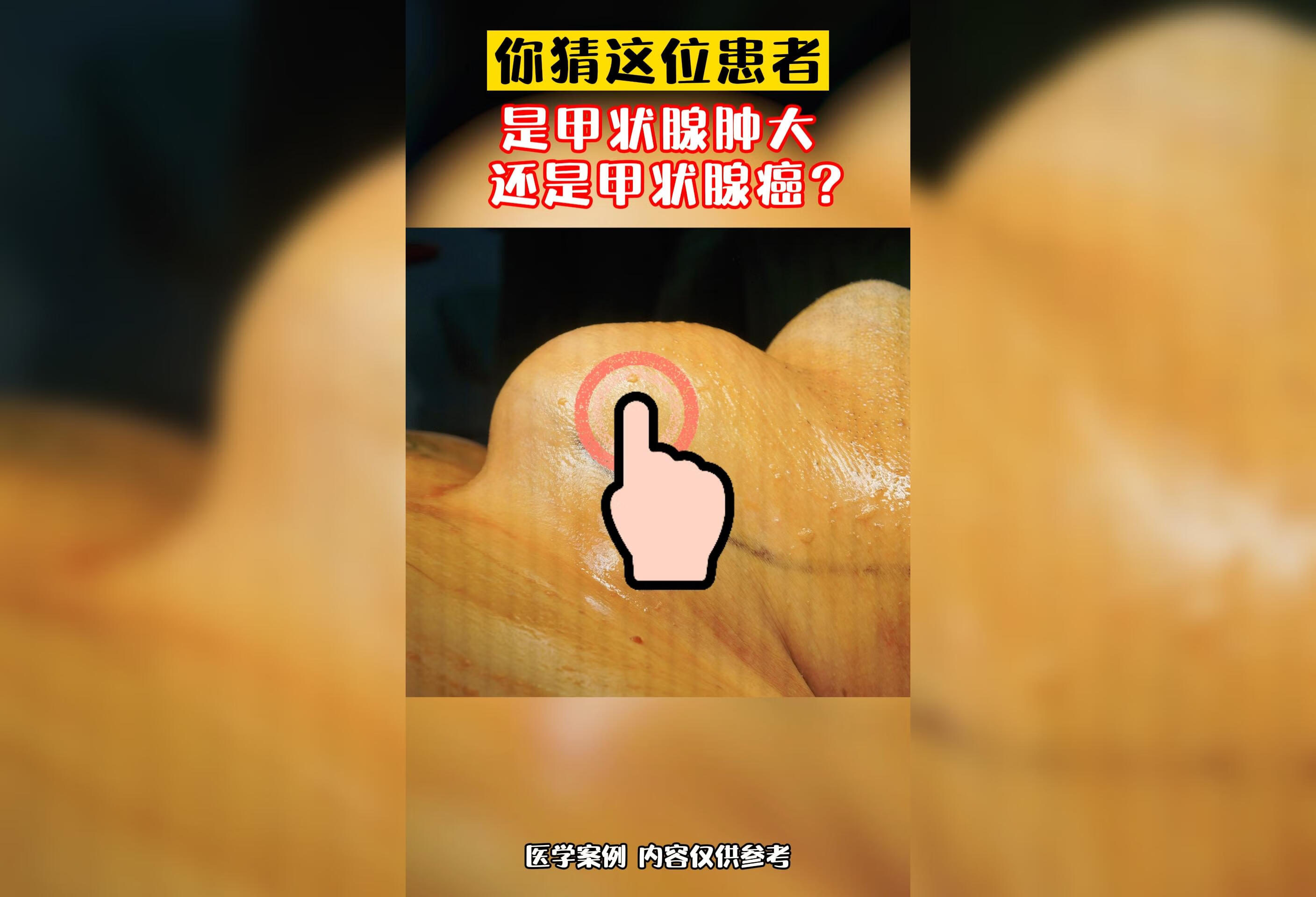 你这到这位患者是甲状腺肿大，还是甲状腺癌吗？