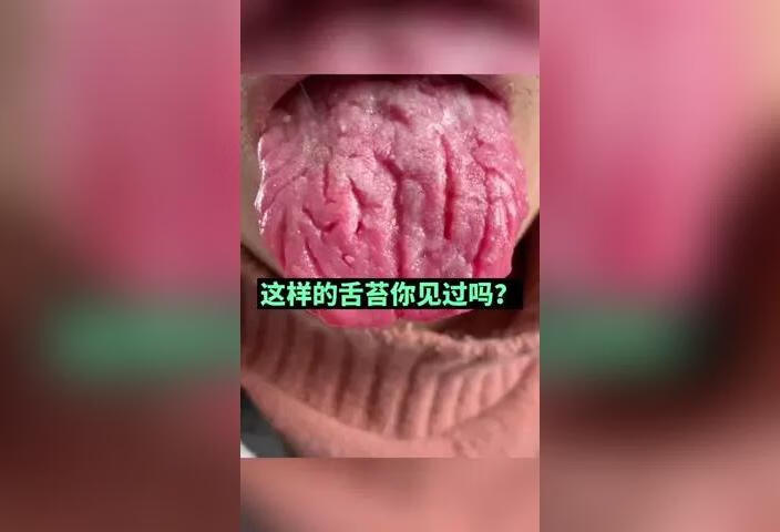 这样的舌苔你见过吗？