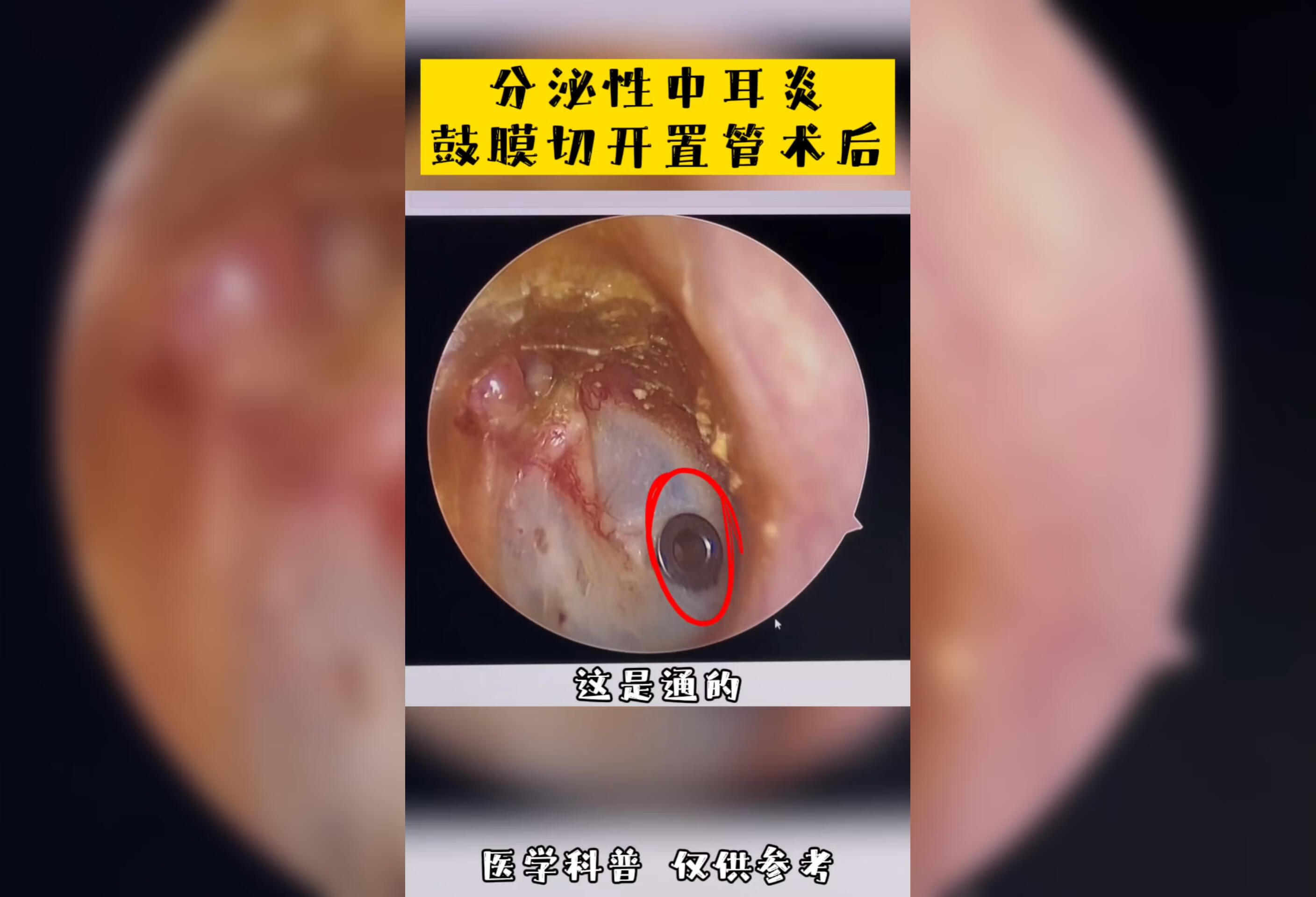 分泌性中耳炎鼓膜切开置管术后