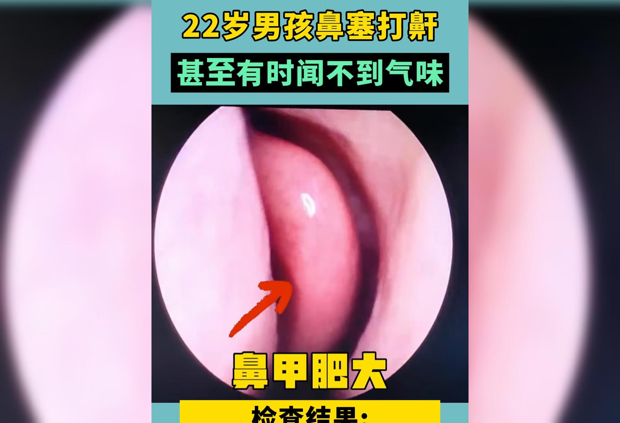 鼻塞打鼾甚至有时候闻不到气味可能是鼻甲肥大