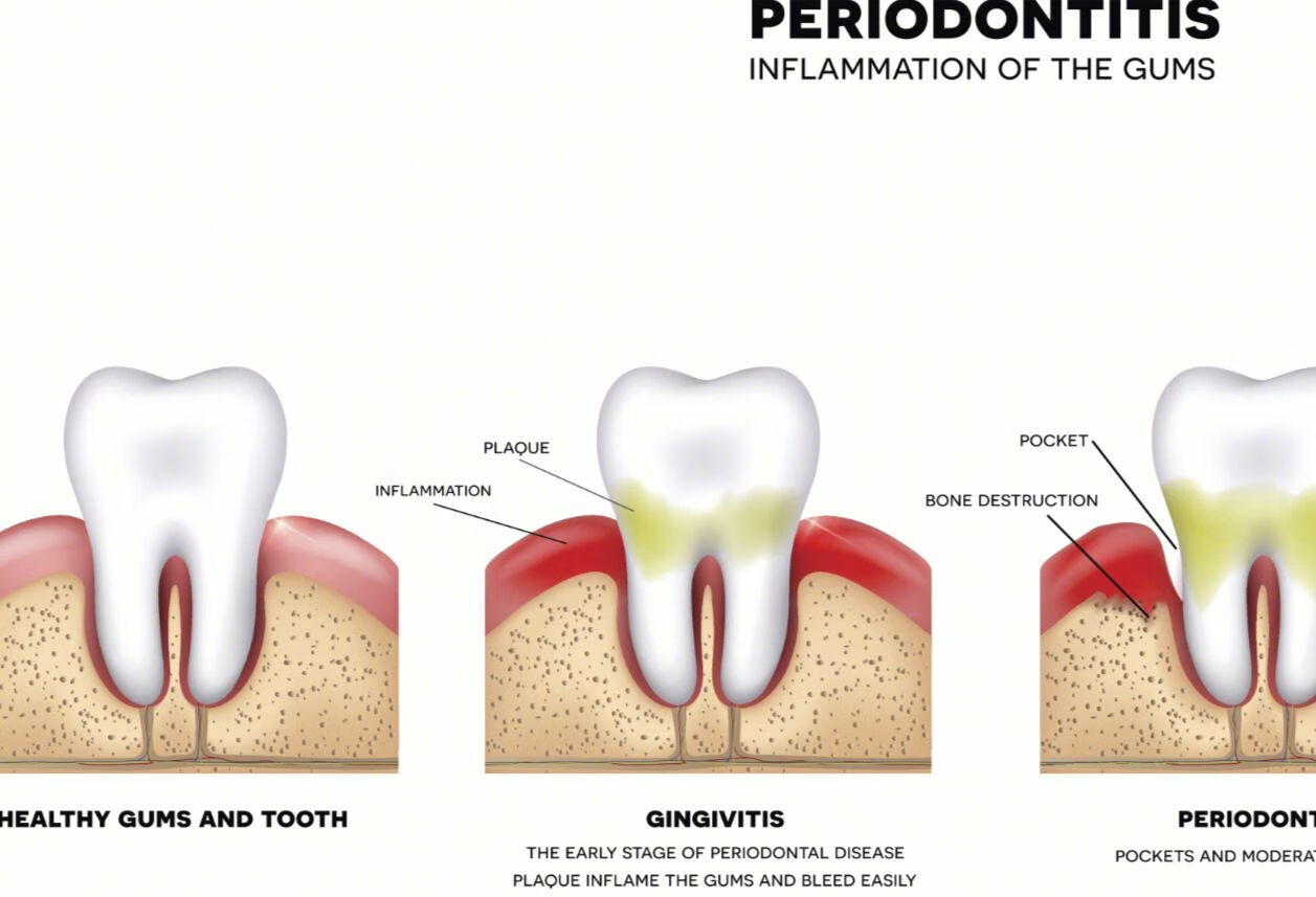 发现牙周炎一定要及时就医