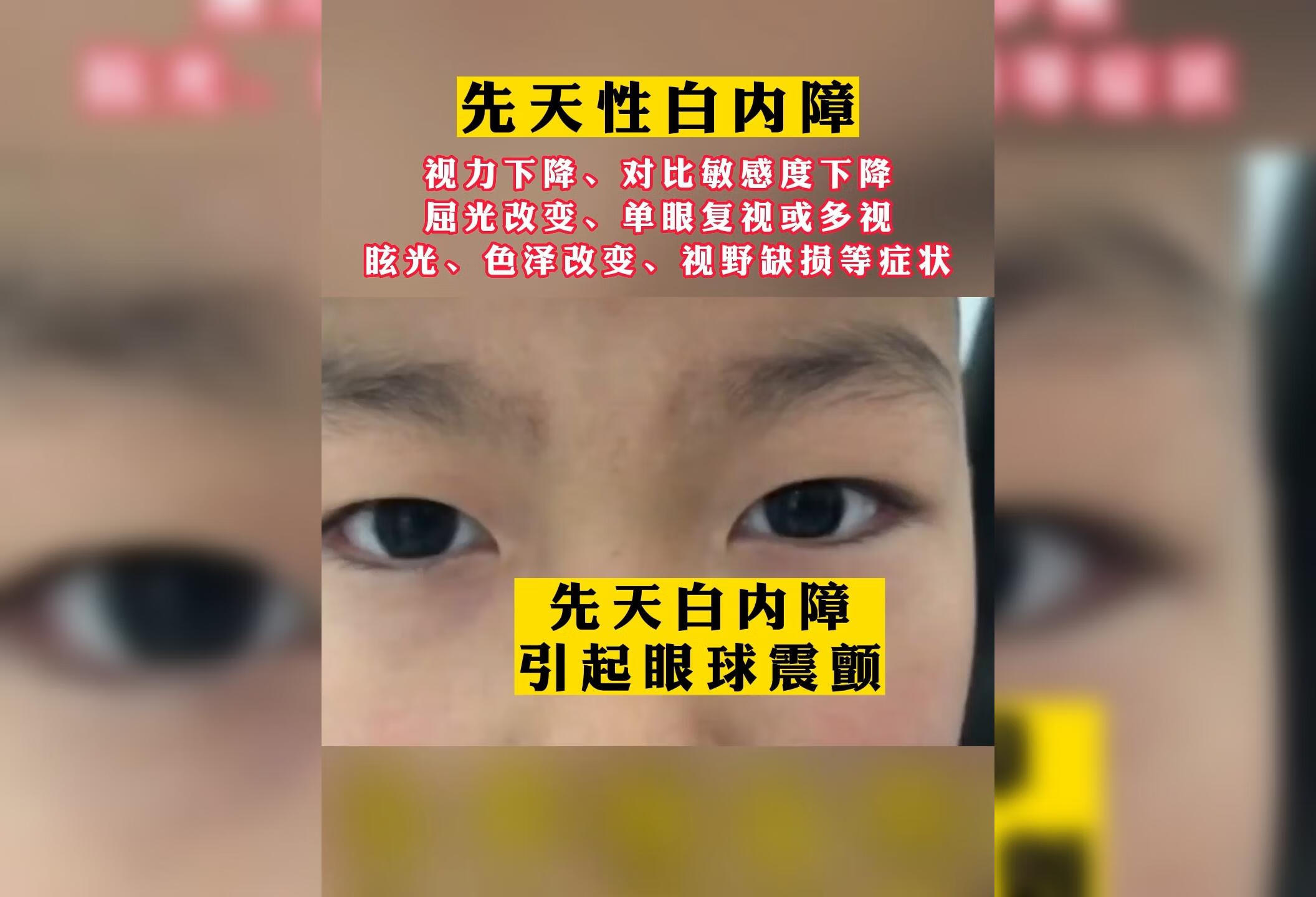 先天性白内障 引起的眼球震颤 