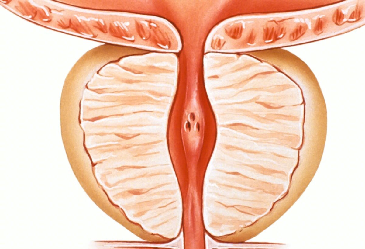 慢性前列腺炎是怎么引起的？
