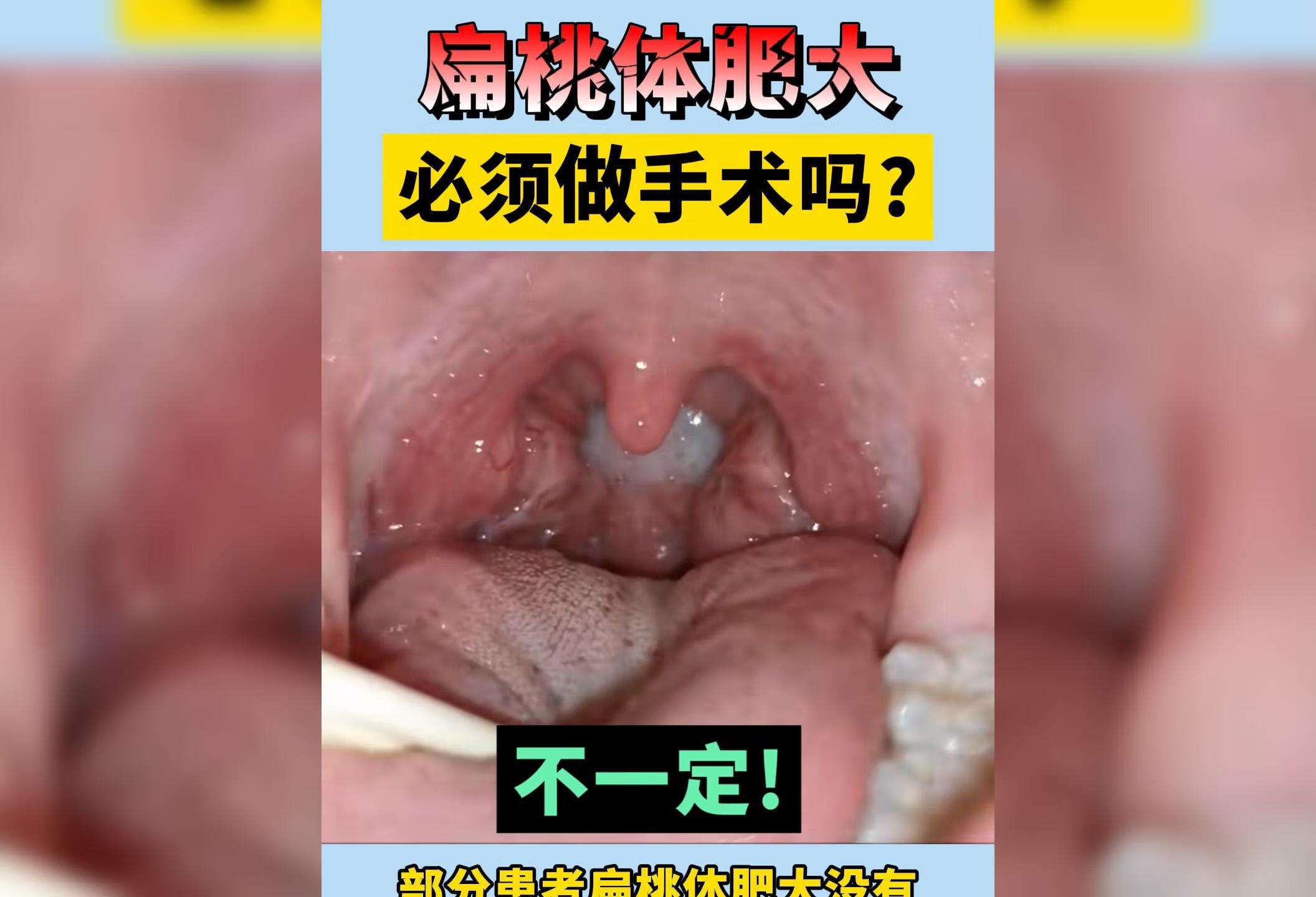 扁桃体肥大必须做手术吗？