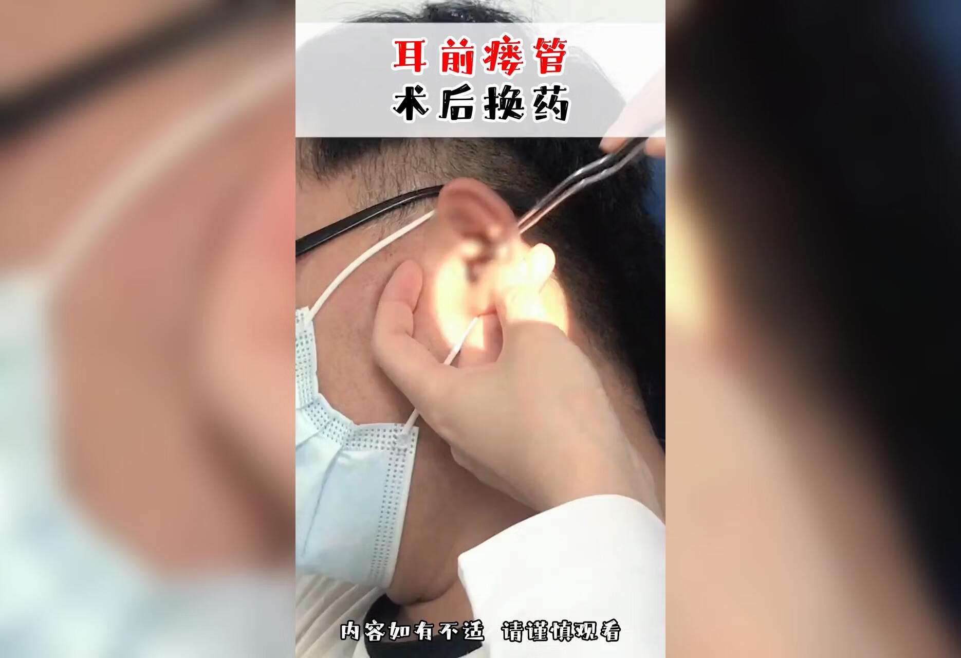 耳前瘘管术后换药全过程