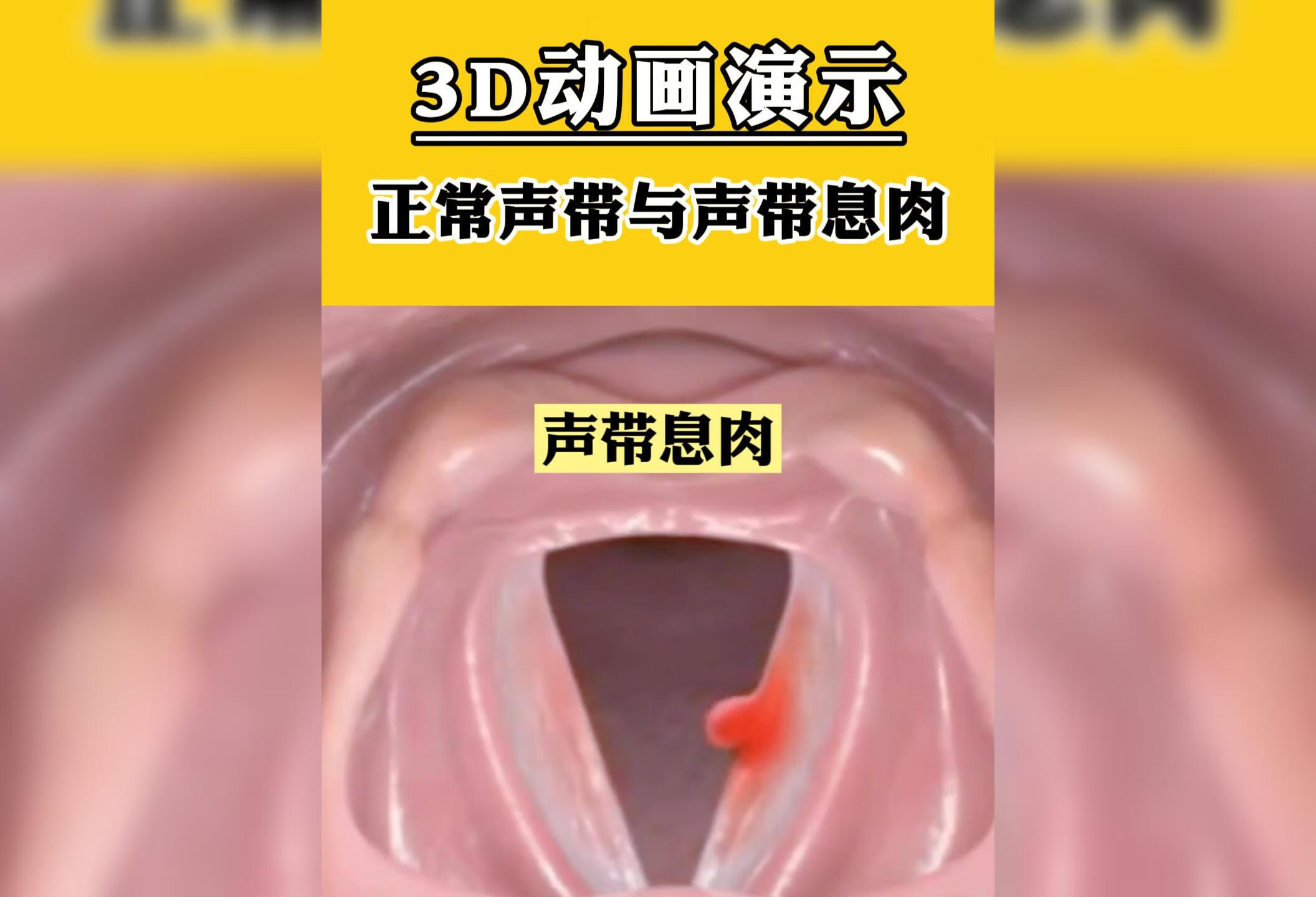 3D动画显示正常声带与声带息肉 