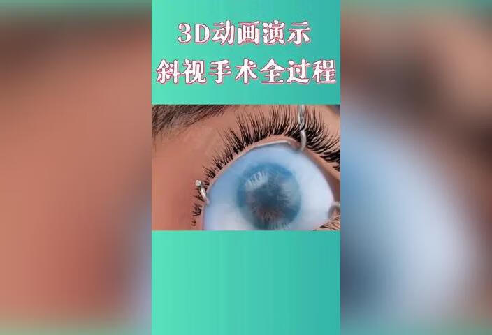 3D动画演示，斜视手术全过程