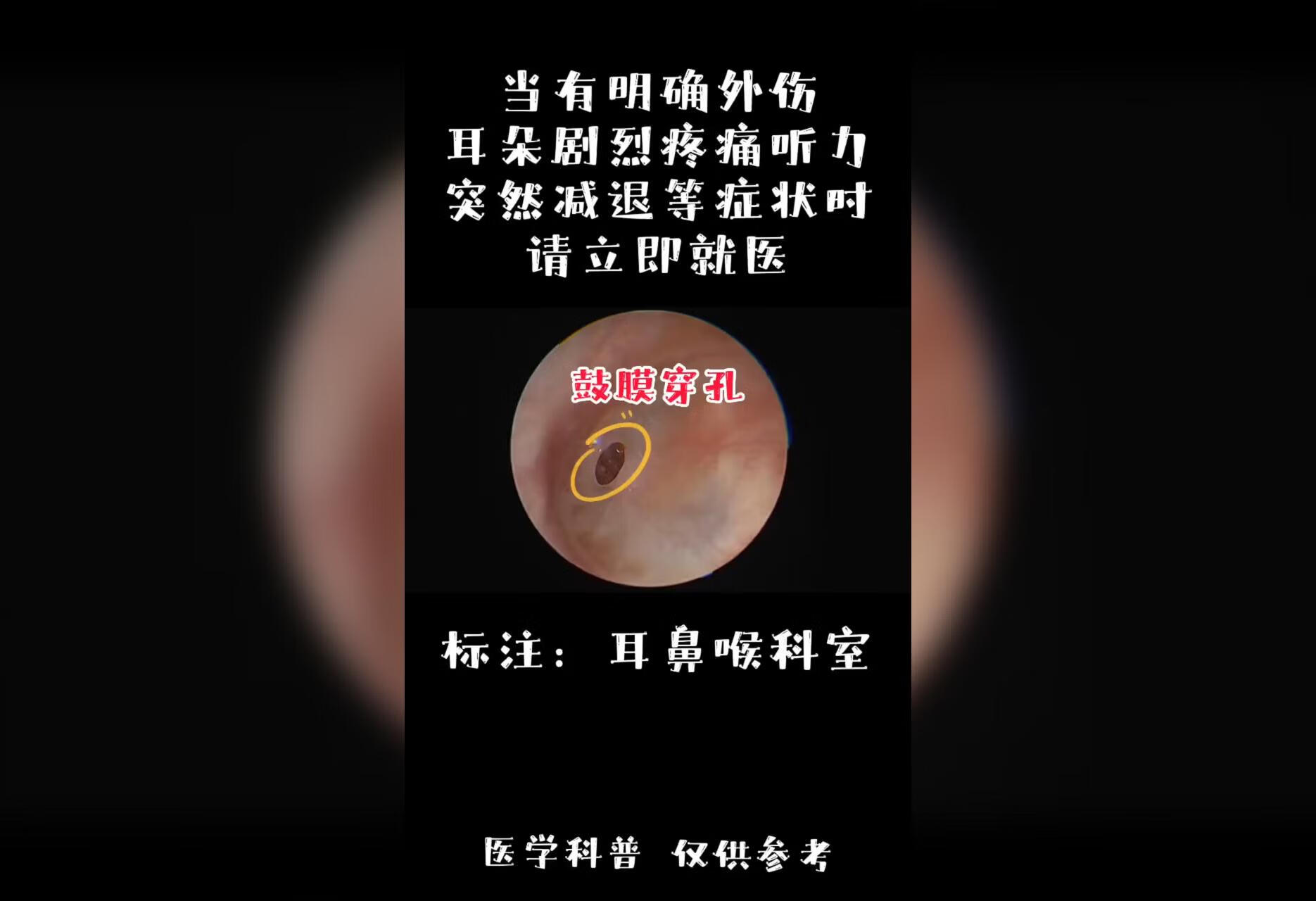 鼓膜穿孔有下述情形请立即就医