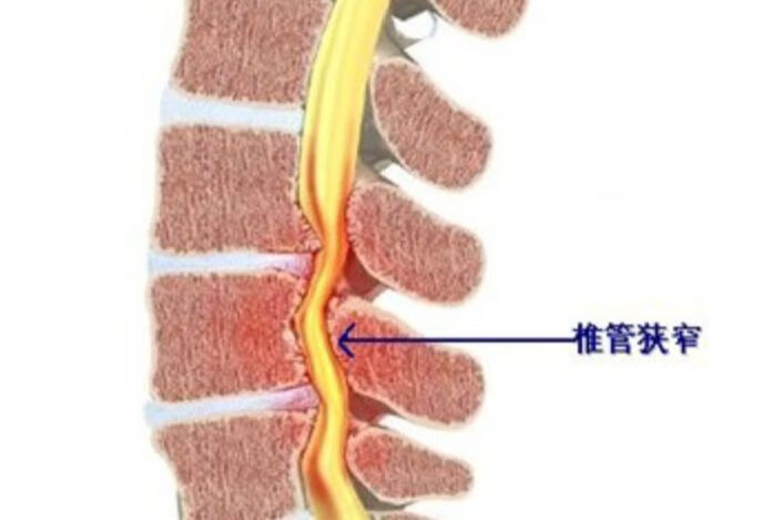 疼痛科科普之腰椎管狭窄