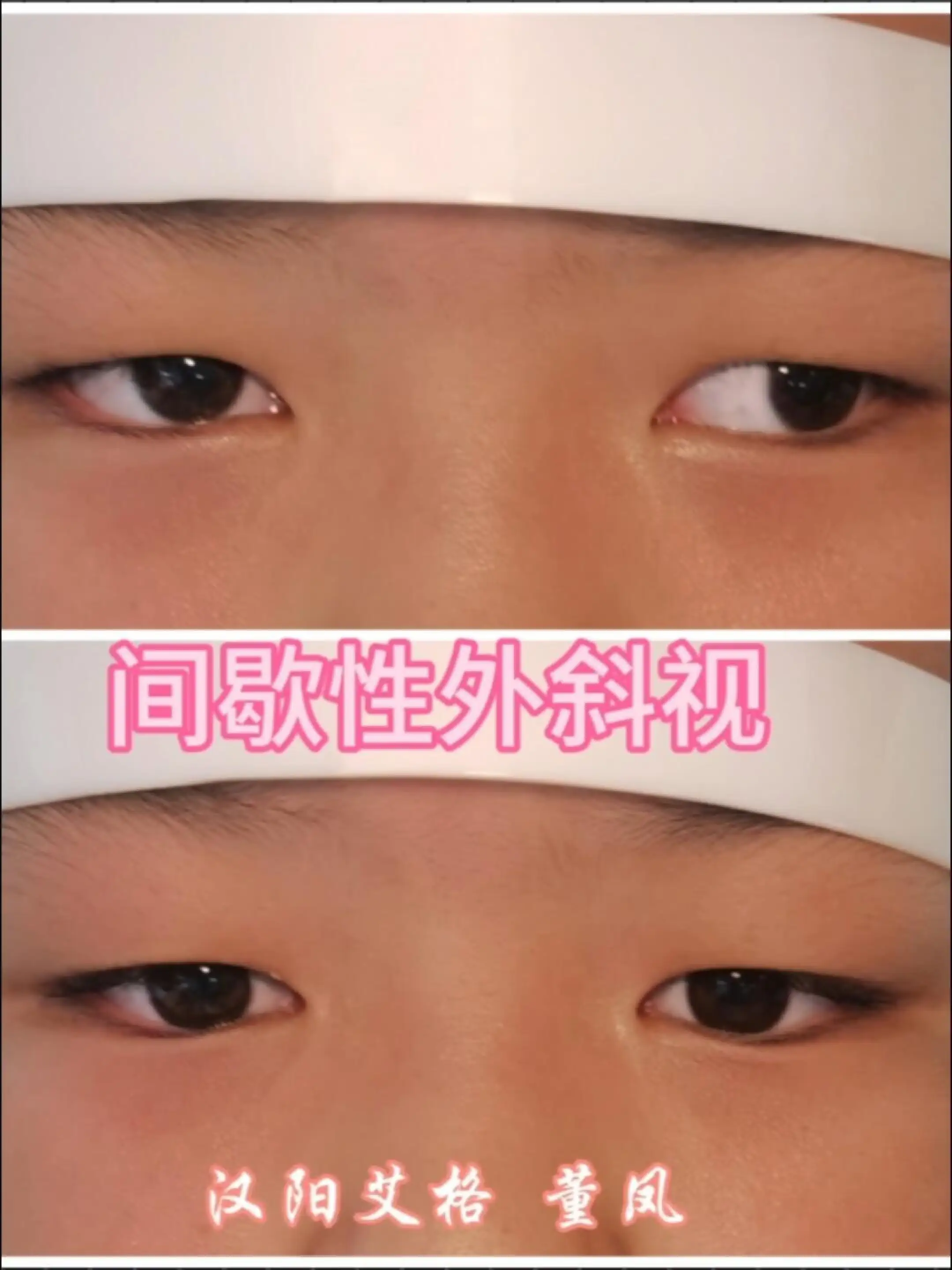 间歇性外斜视