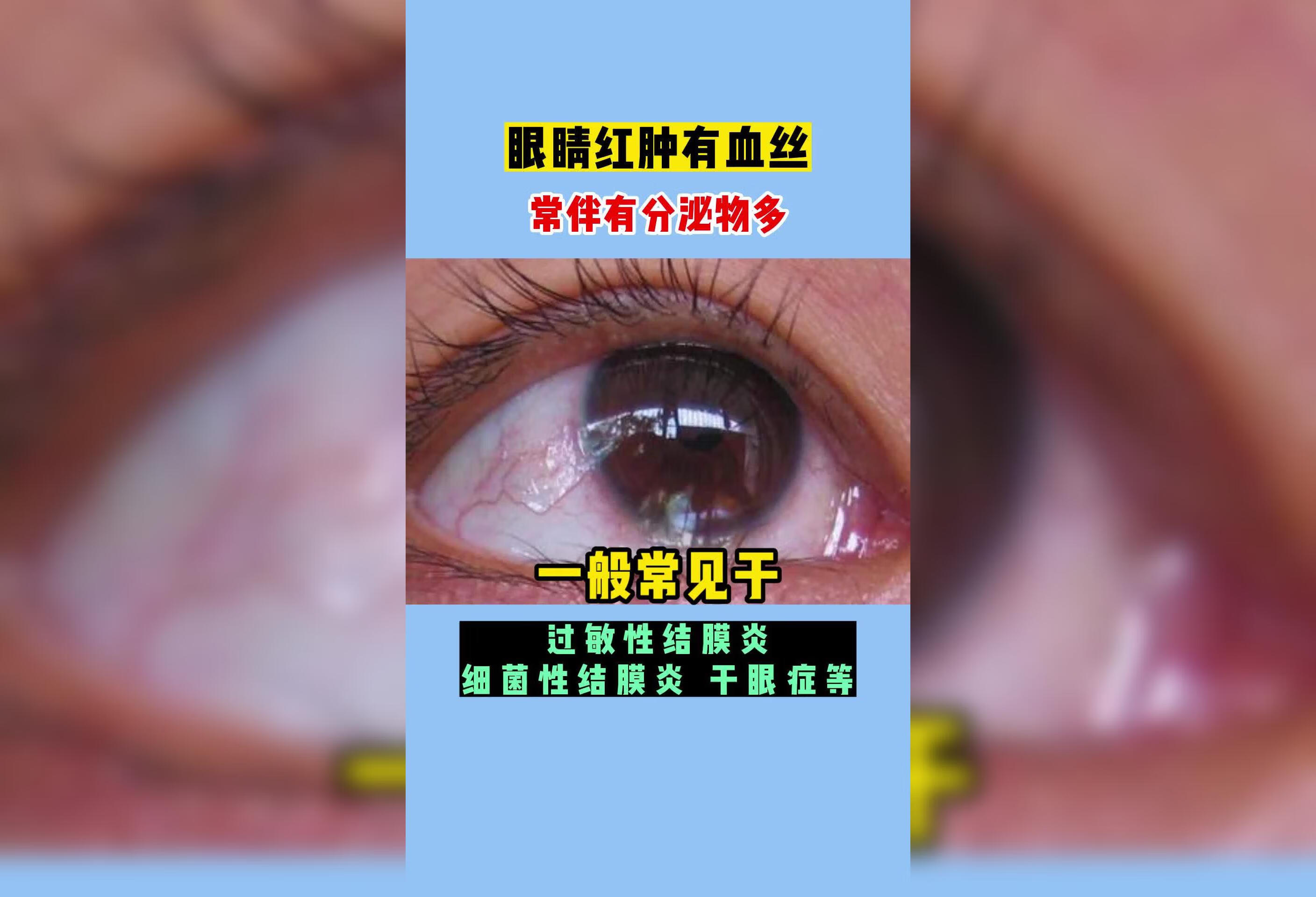 眼睛红肿有血丝是为什么