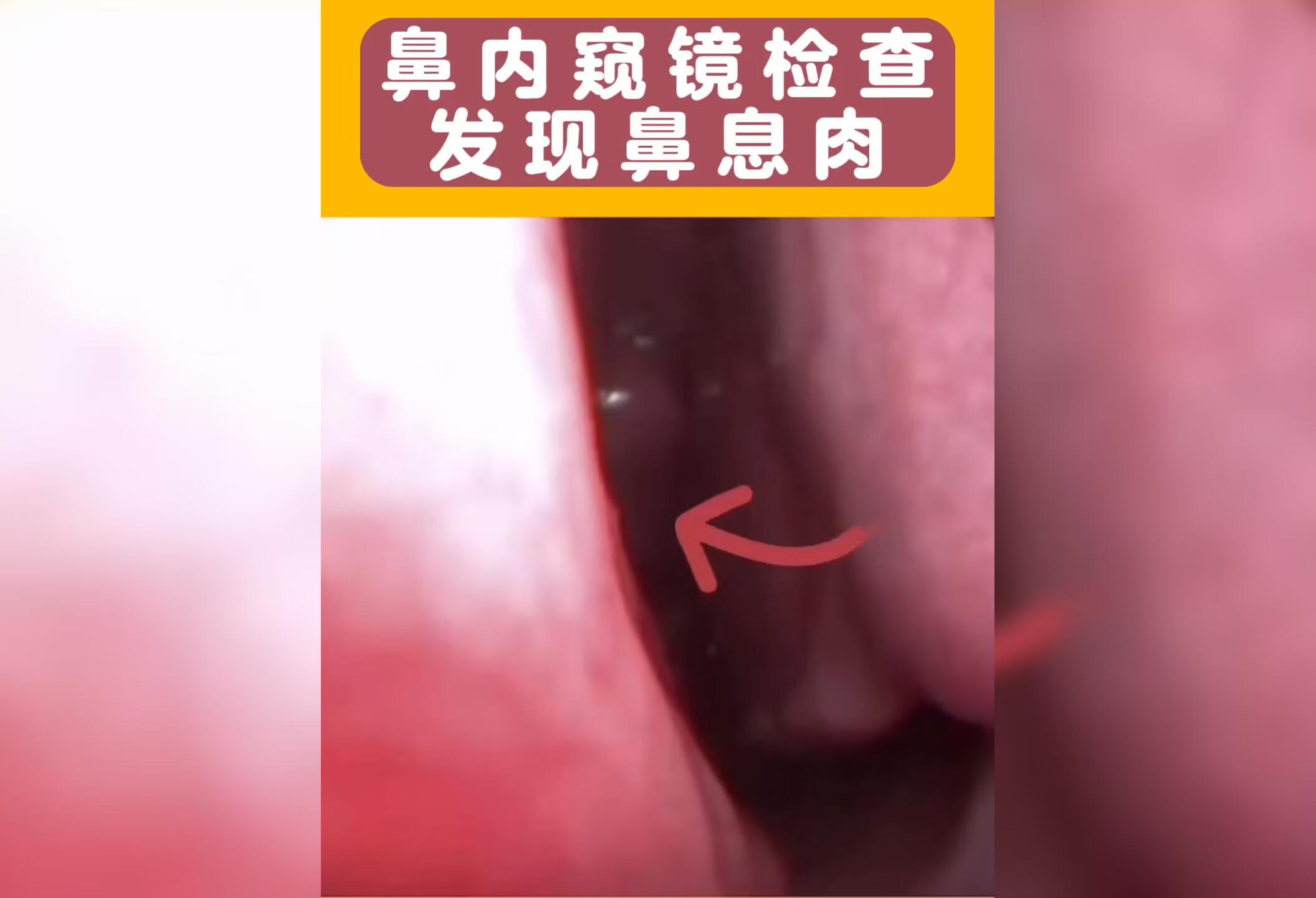 鼻内镜下的鼻息肉 