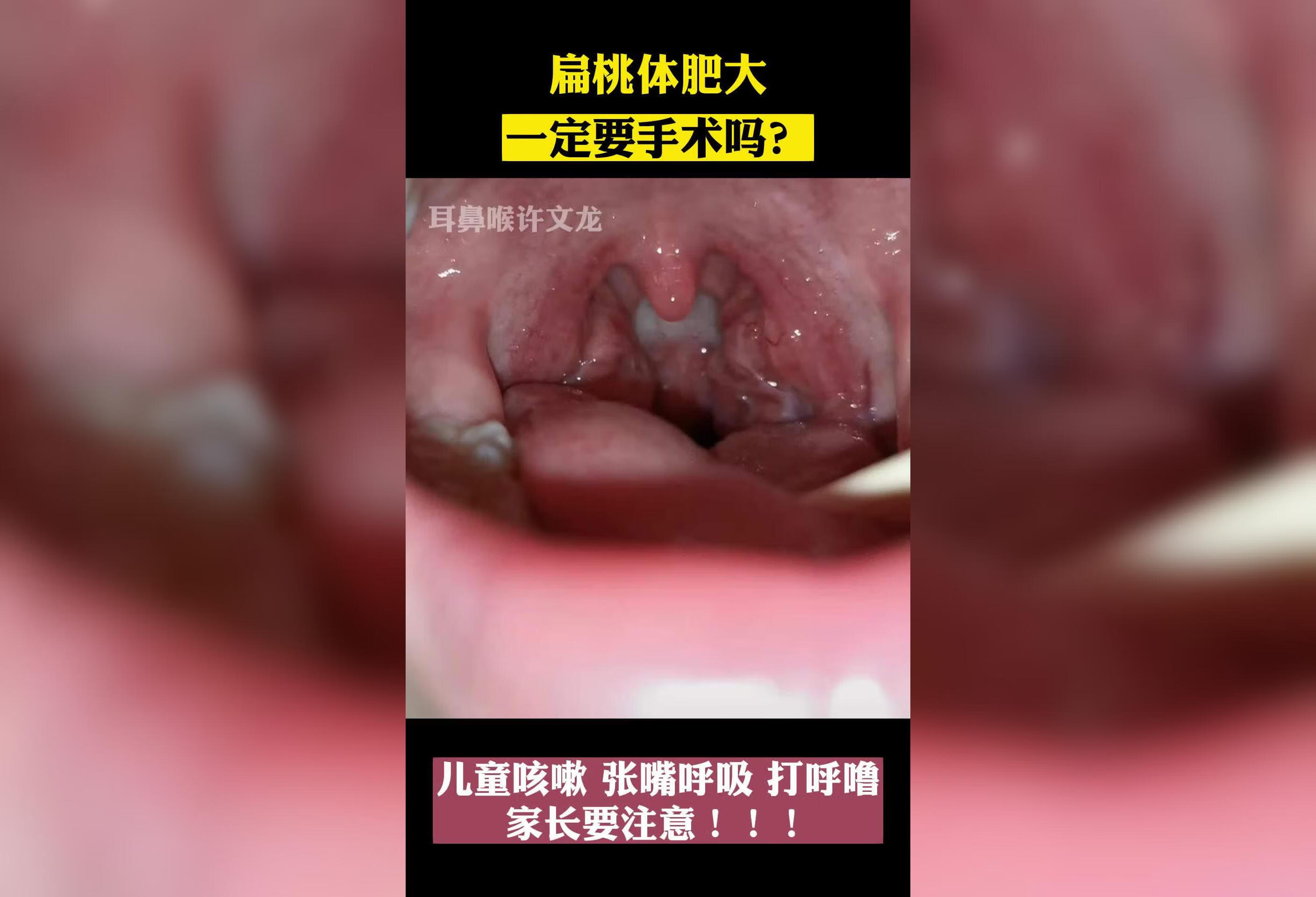 扁桃体肥大不一定都要手术