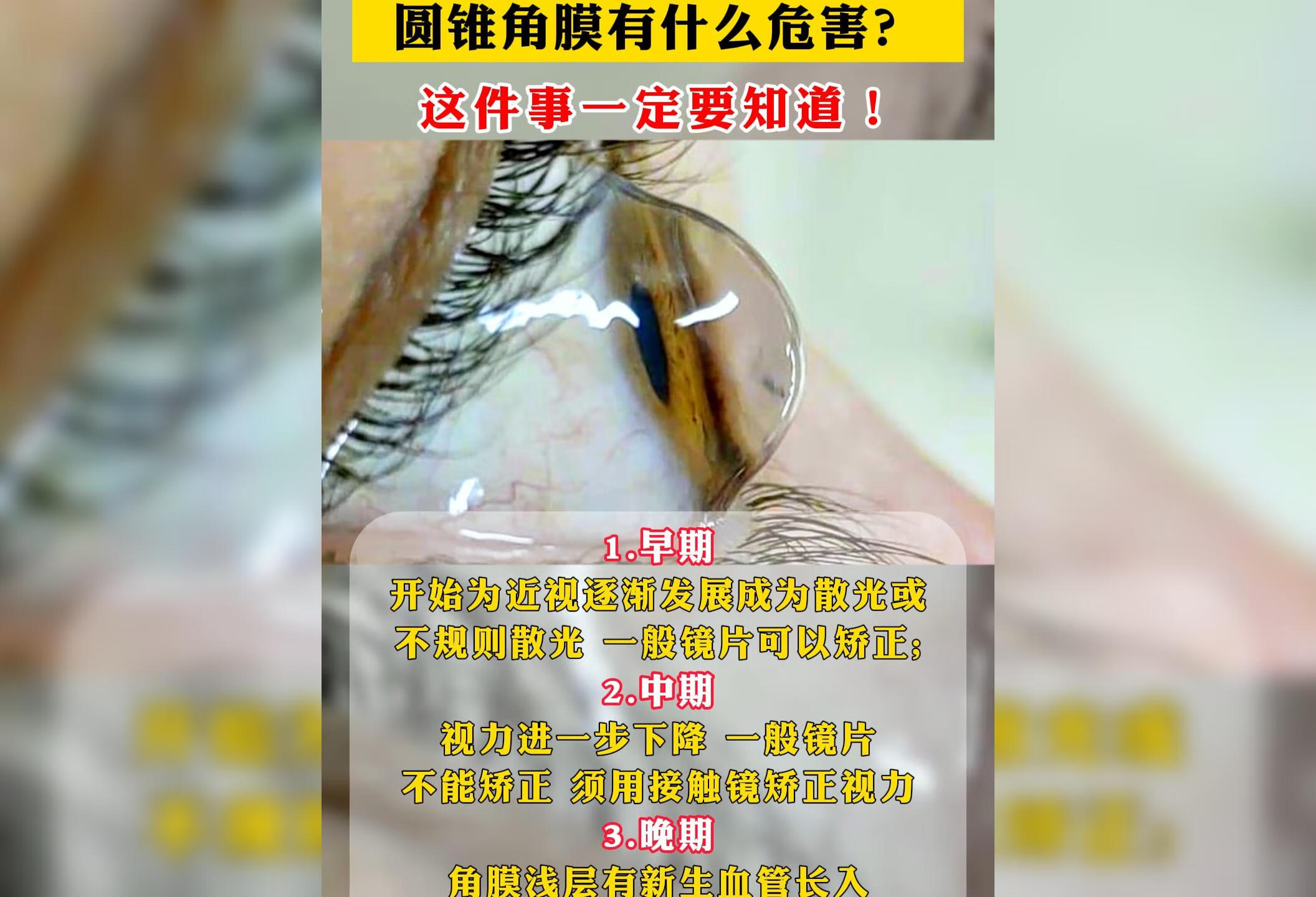 圆锥角膜有什么危害？