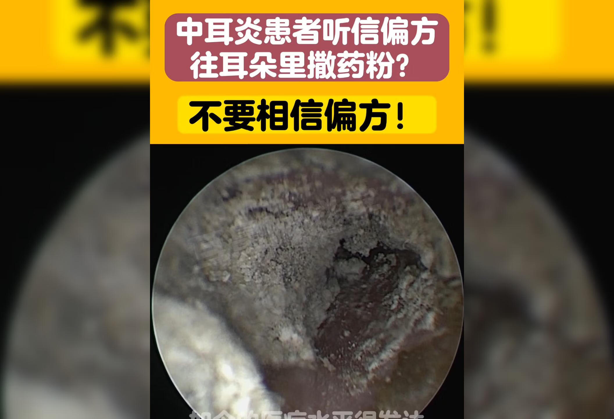 中耳炎患者请不要相信偏方