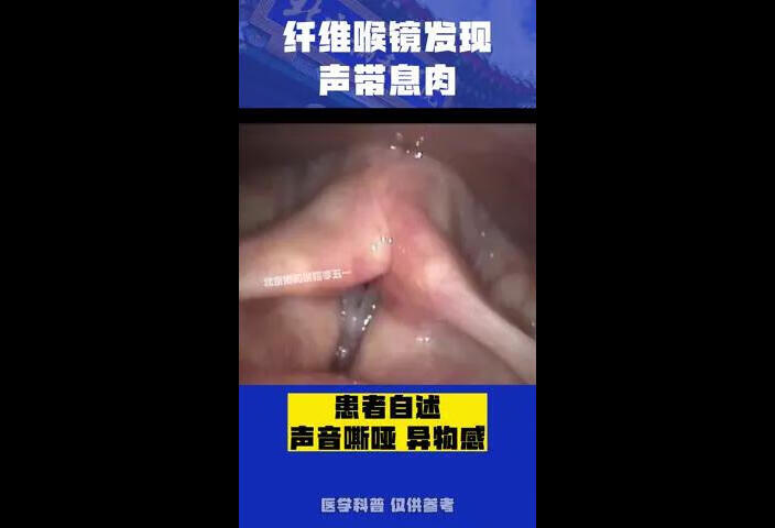 患者声音嘶哑，做纤维喉镜发现声带息肉