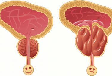 营养师：这些食物或许对改善前列腺炎有帮助！可以尝试