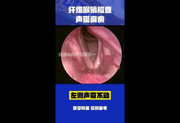 患者声音嘶哑，做喉镜发现声带麻痹