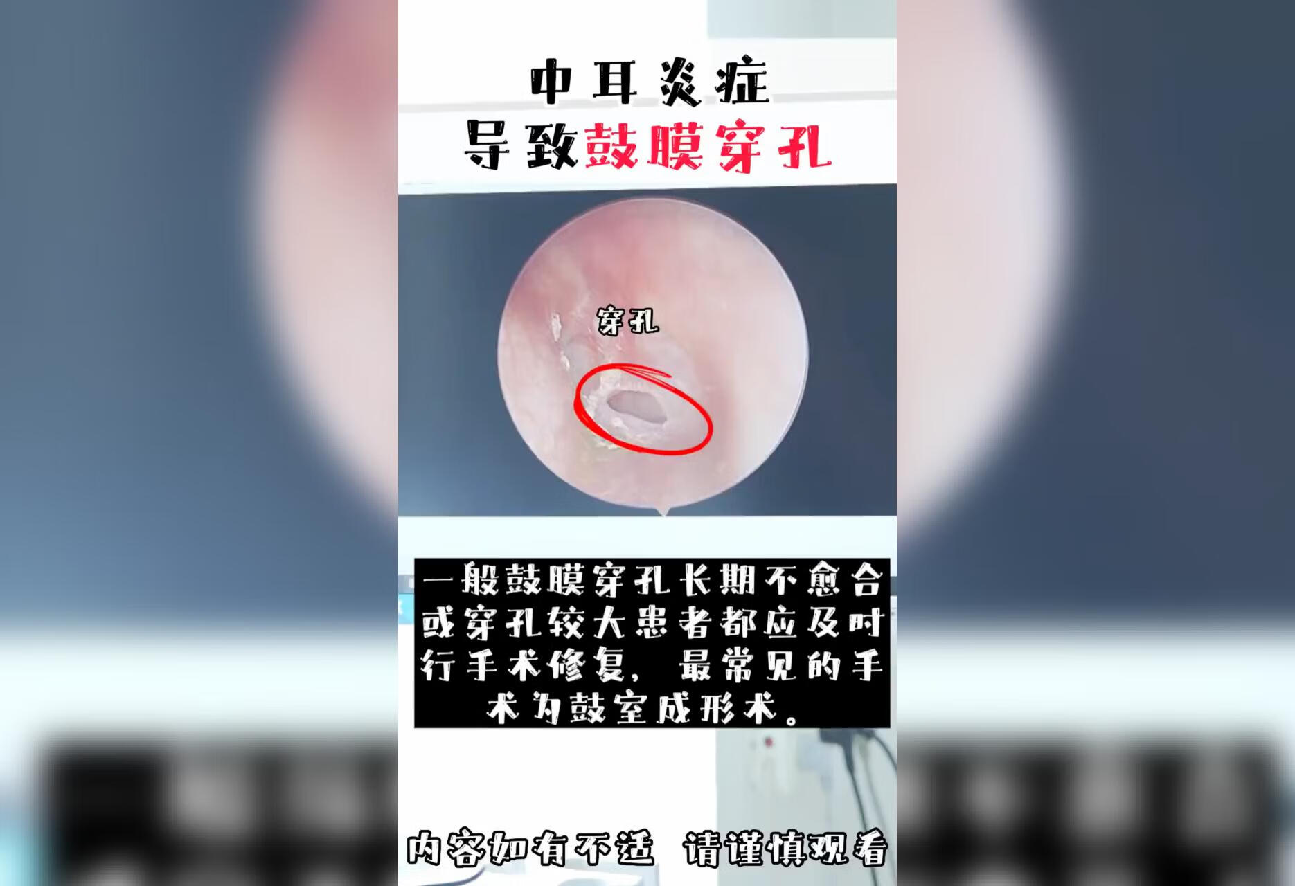 长期鼓膜穿孔不愈合需行鼓室成形治疗