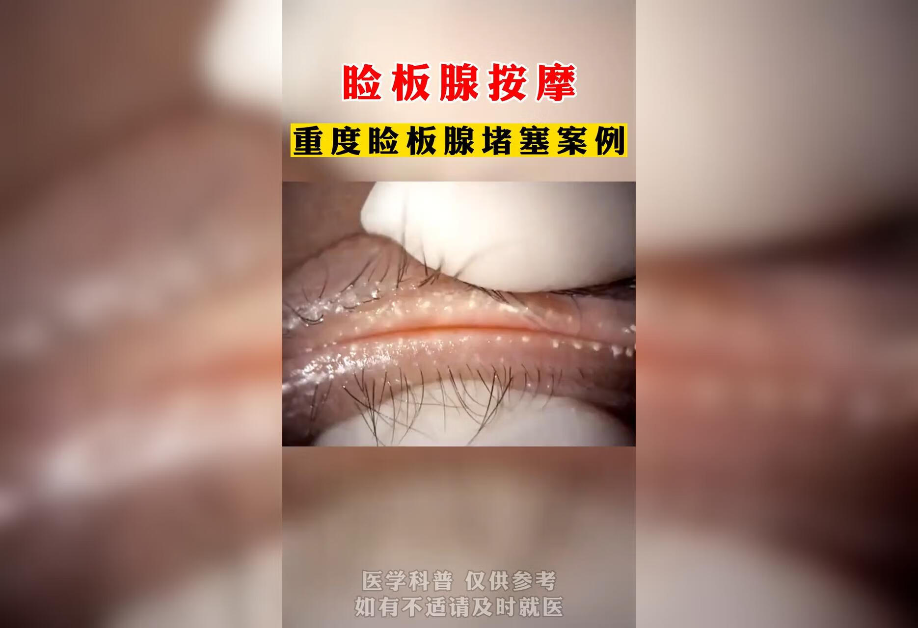 睑板腺堵塞可以做睑板腺按摩