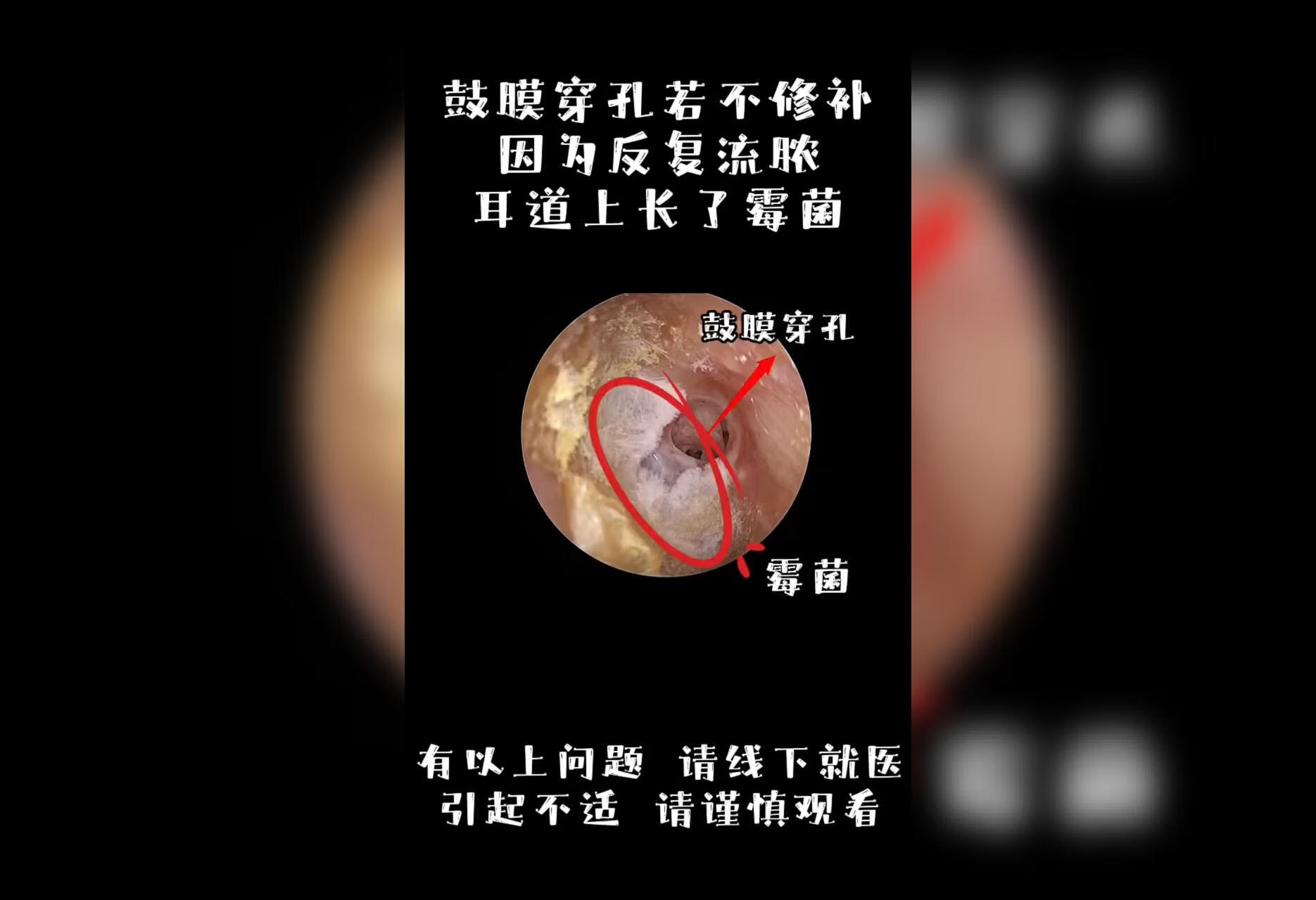 鼓膜穿孔因为反复流脓导致耳道上长了霉菌