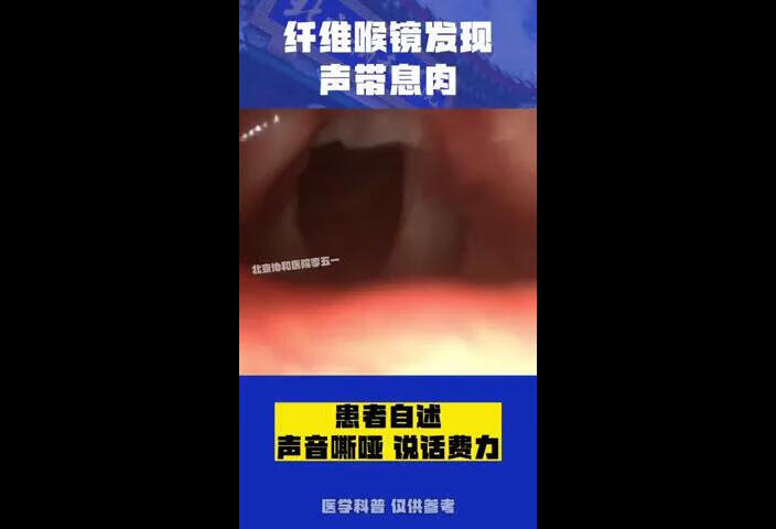 纤维喉镜发现声带息肉